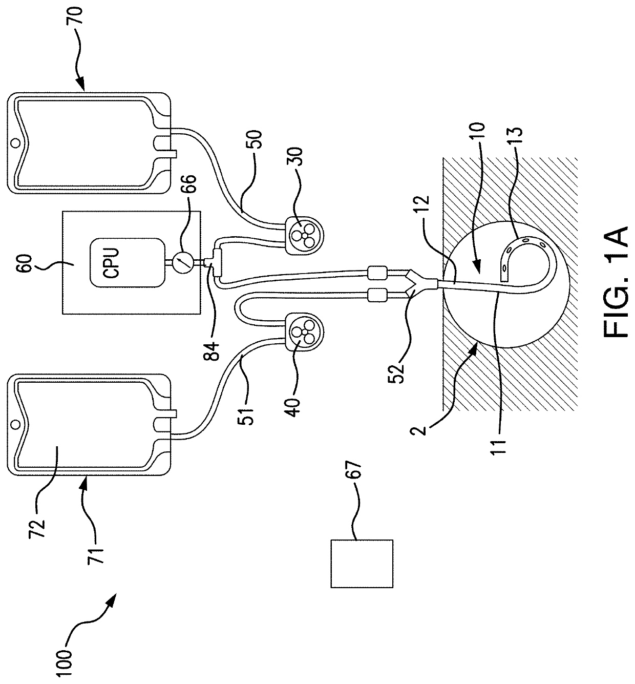 Systems and methods for percutaneous drainage