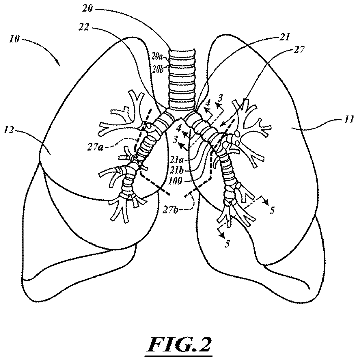 Systems, devices, and methods for treating a pulmonary disease with ultrasound energy