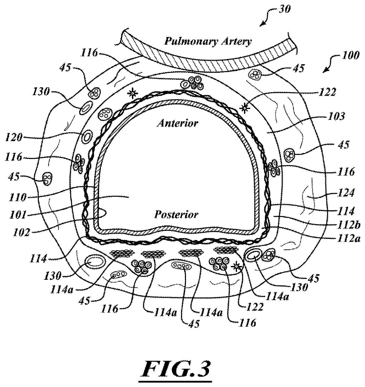 Systems, devices, and methods for treating a pulmonary disease with ultrasound energy