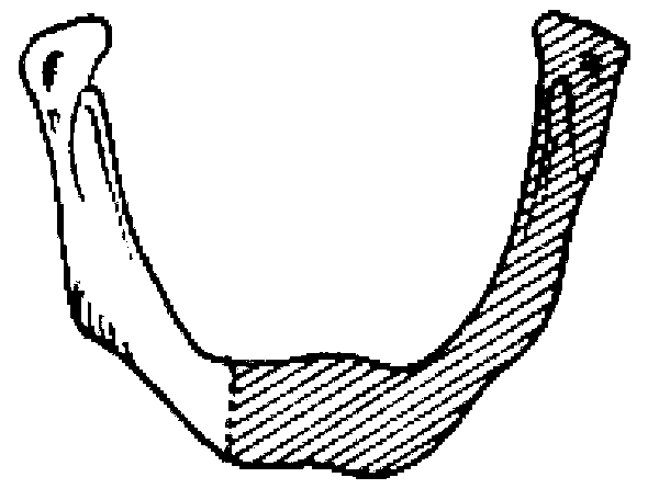 Manufacturing method for personalized bracket for repairing of center plane across mandibular defect