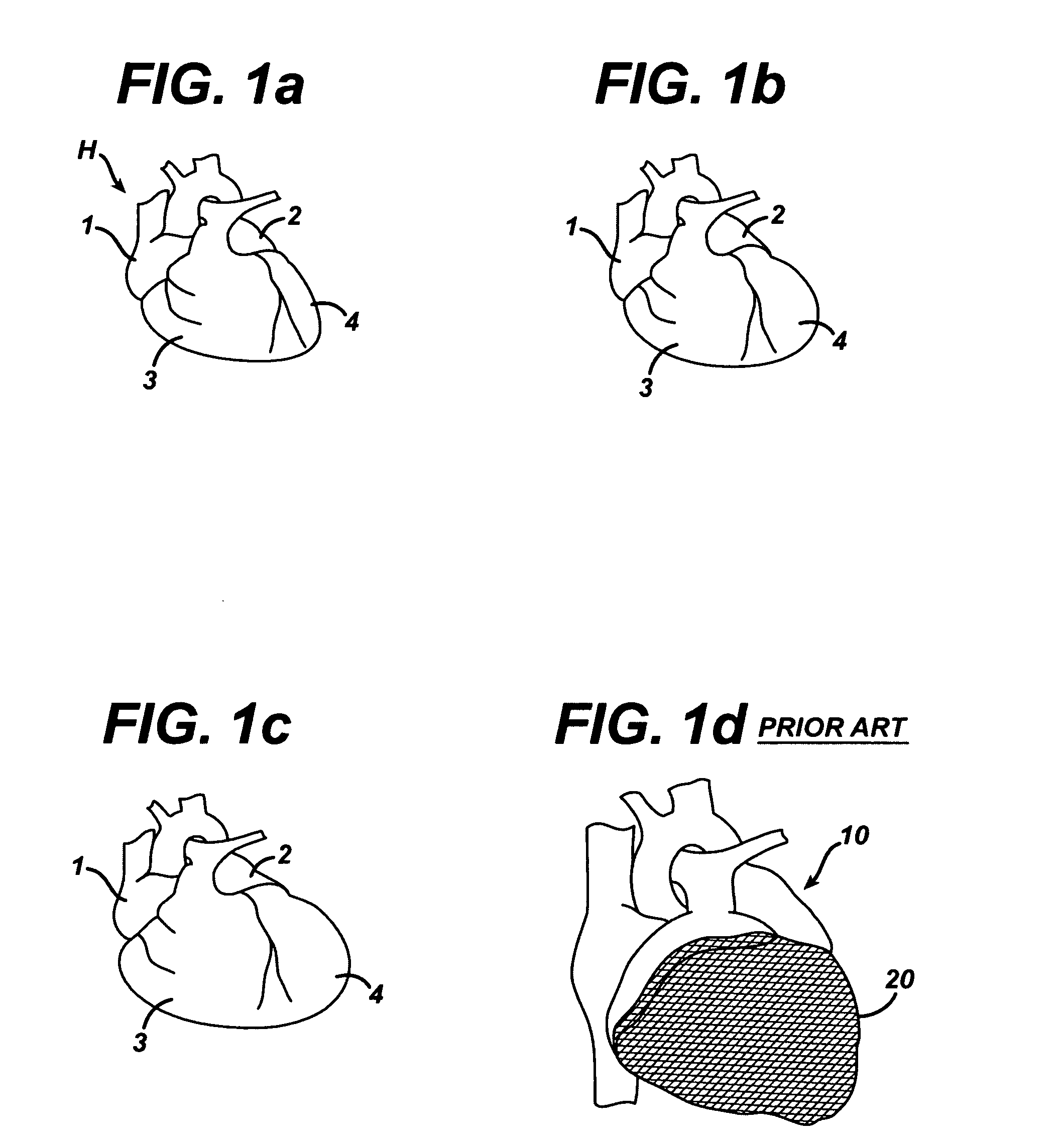 Systems and methods for assisting cardiac valve coaptation