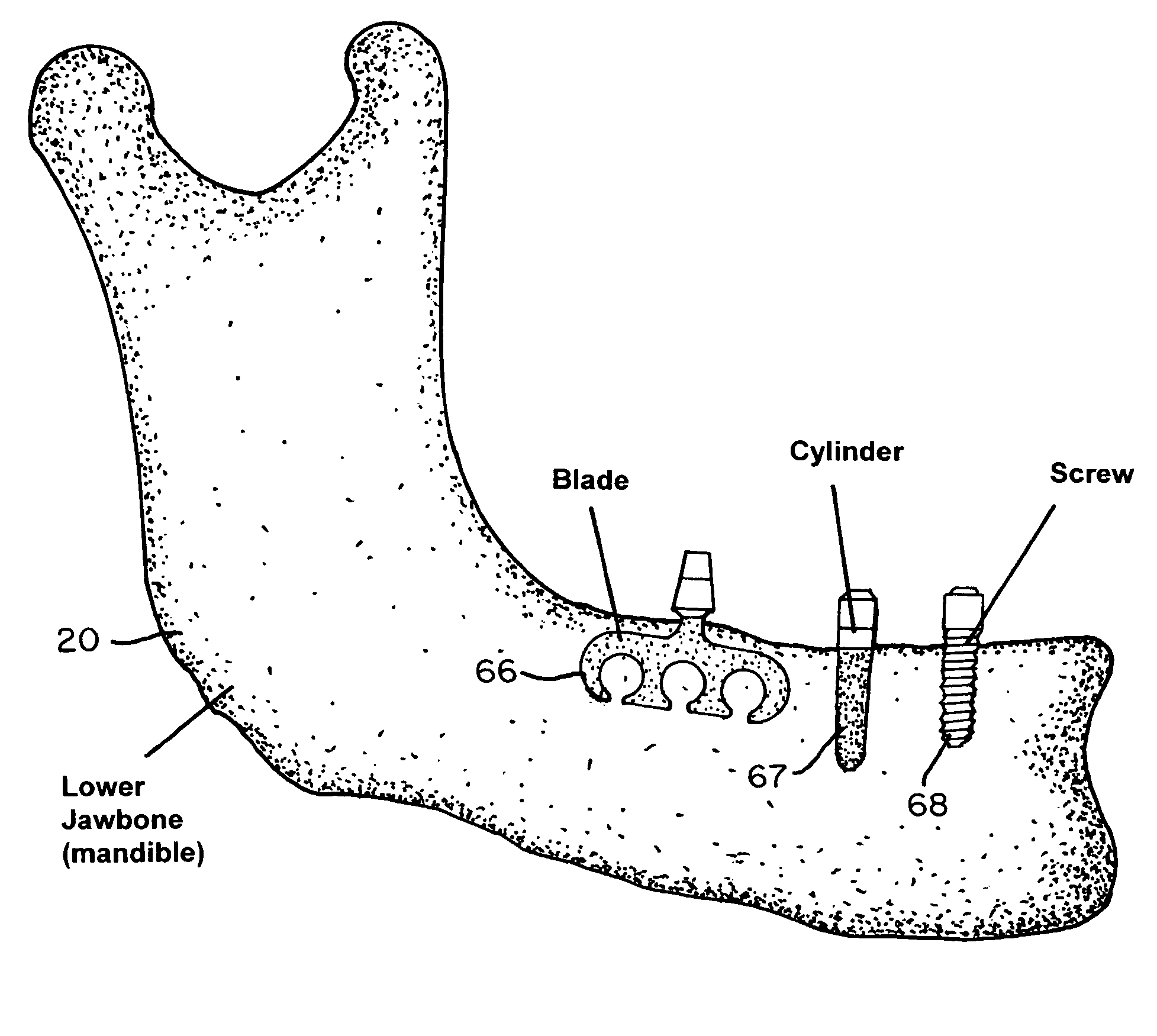 Magnetically implantable prosthetic device and method to shorten healing time, enhance bone fusion, and retard bacterial growth