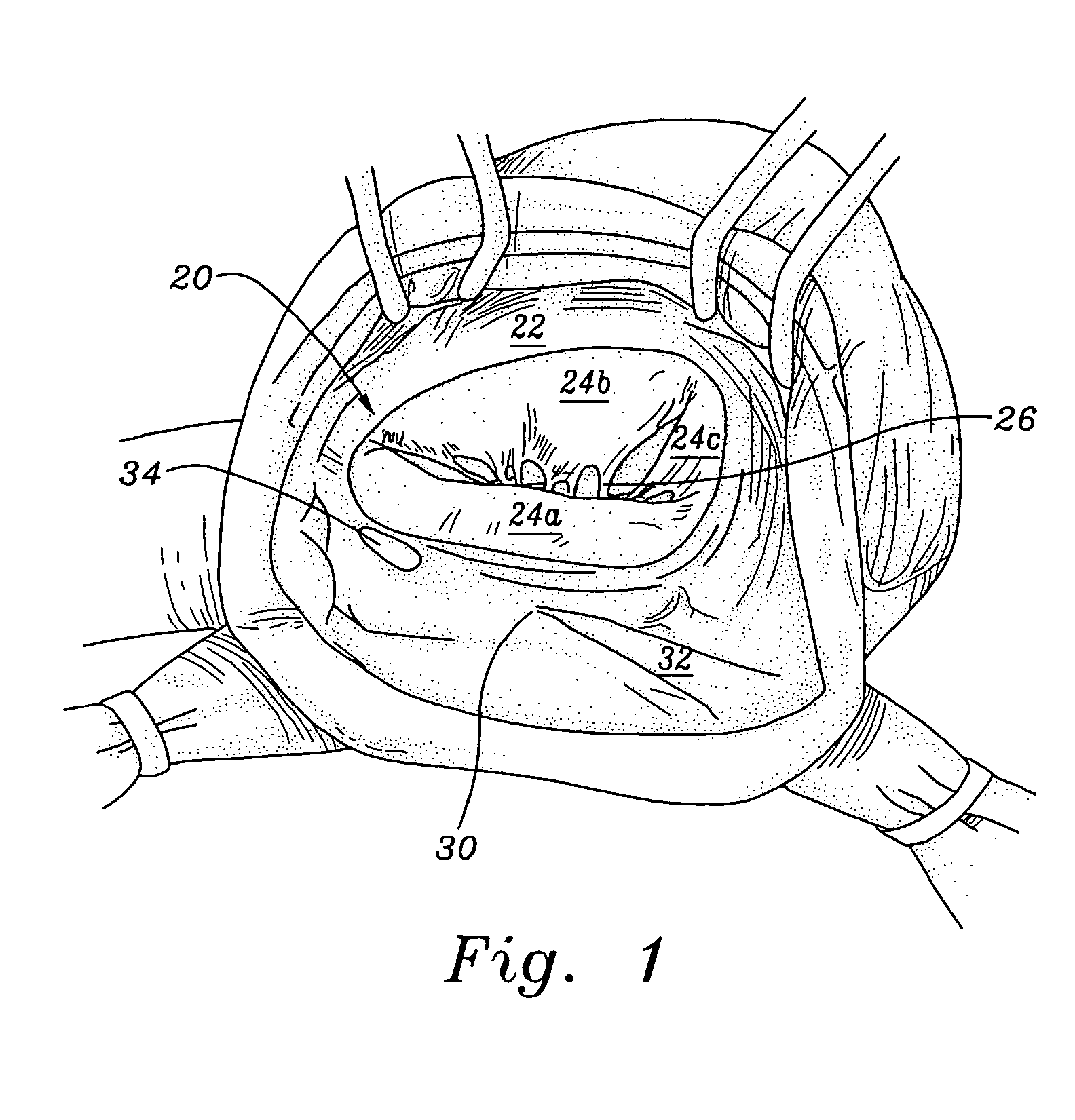 Conformal tricuspid annuloplasty ring and template