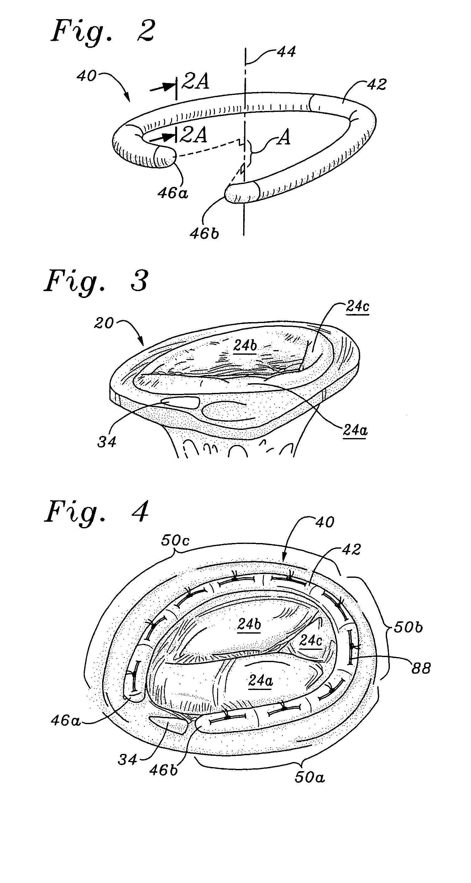 Conformal tricuspid annuloplasty ring and template