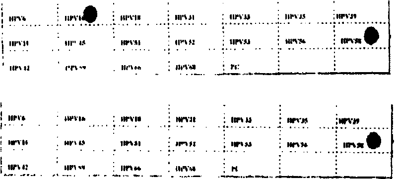 Human papilomavirus typing gene chip detecting system