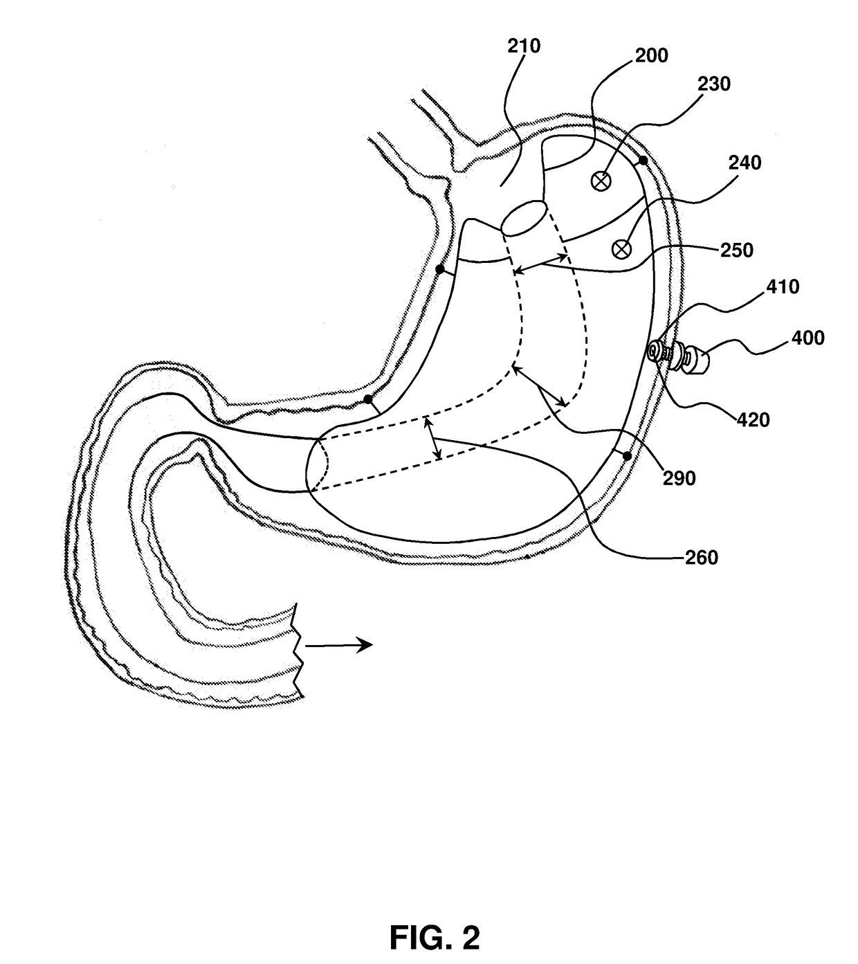 Sleeve-anchorable gastric balloon for weight loss