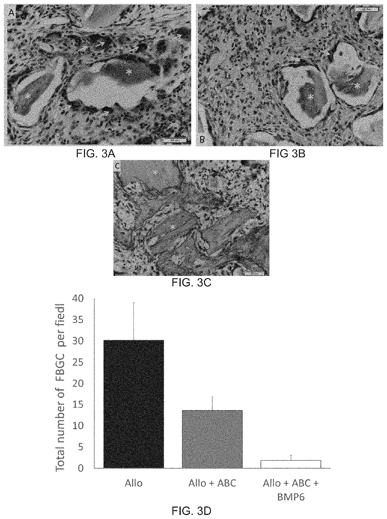 Autologous Bone Graft Substitute