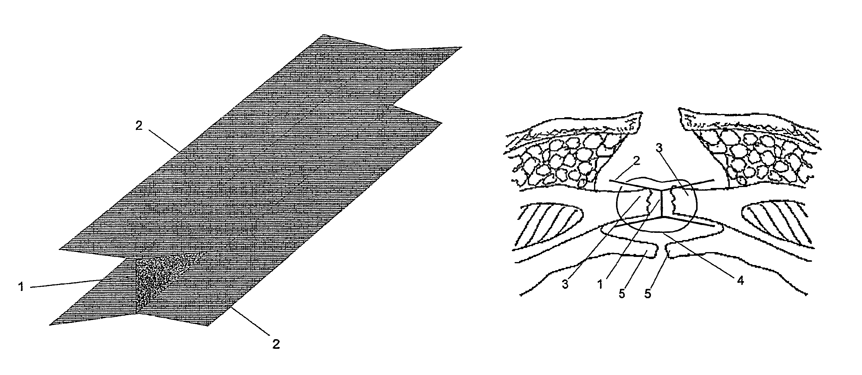 Wall prosthesis that can be implanted in the center of a wound to reinforce abdominal wall closure