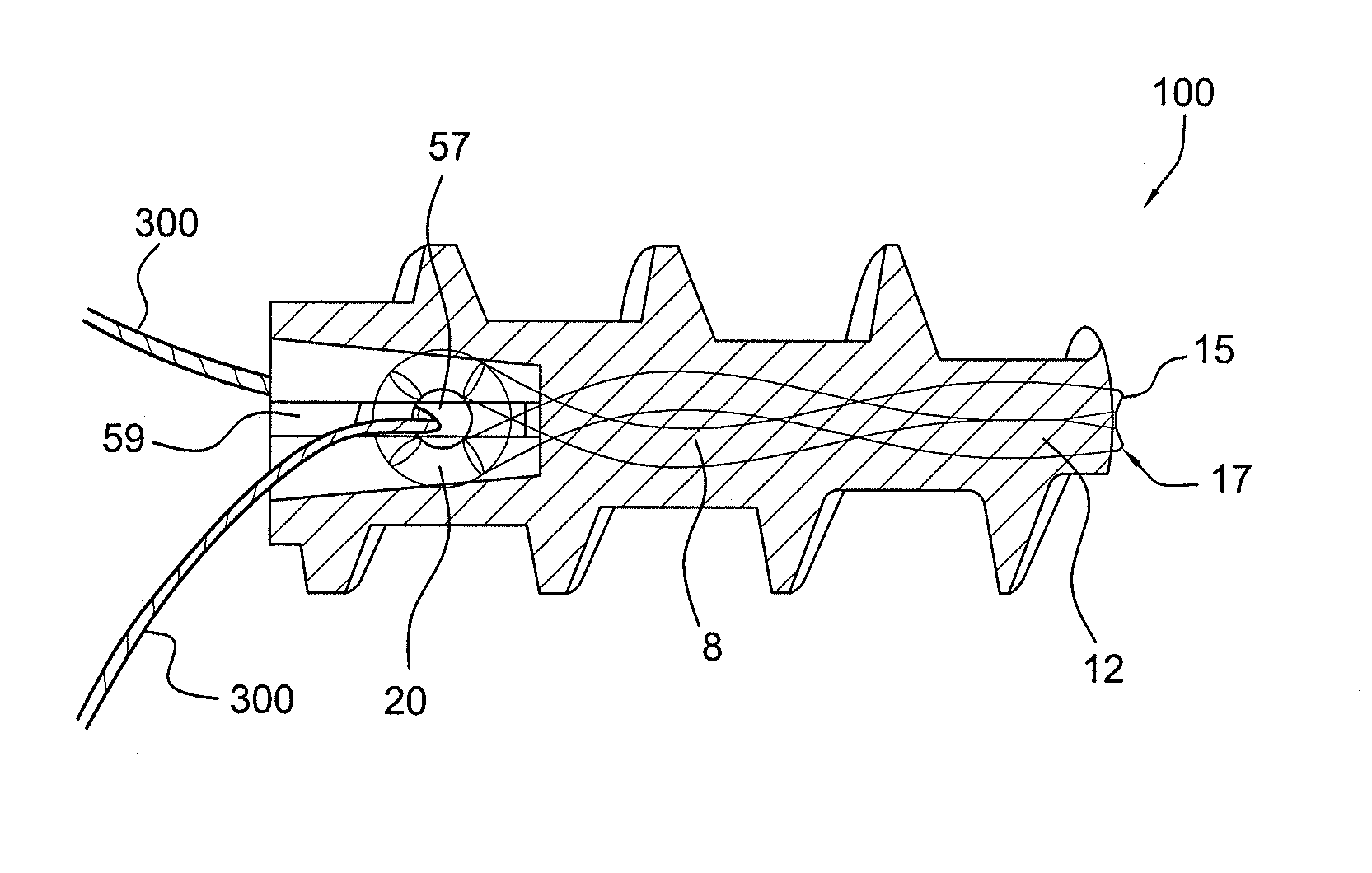 Fully threaded suture anchor with insert-molded suture