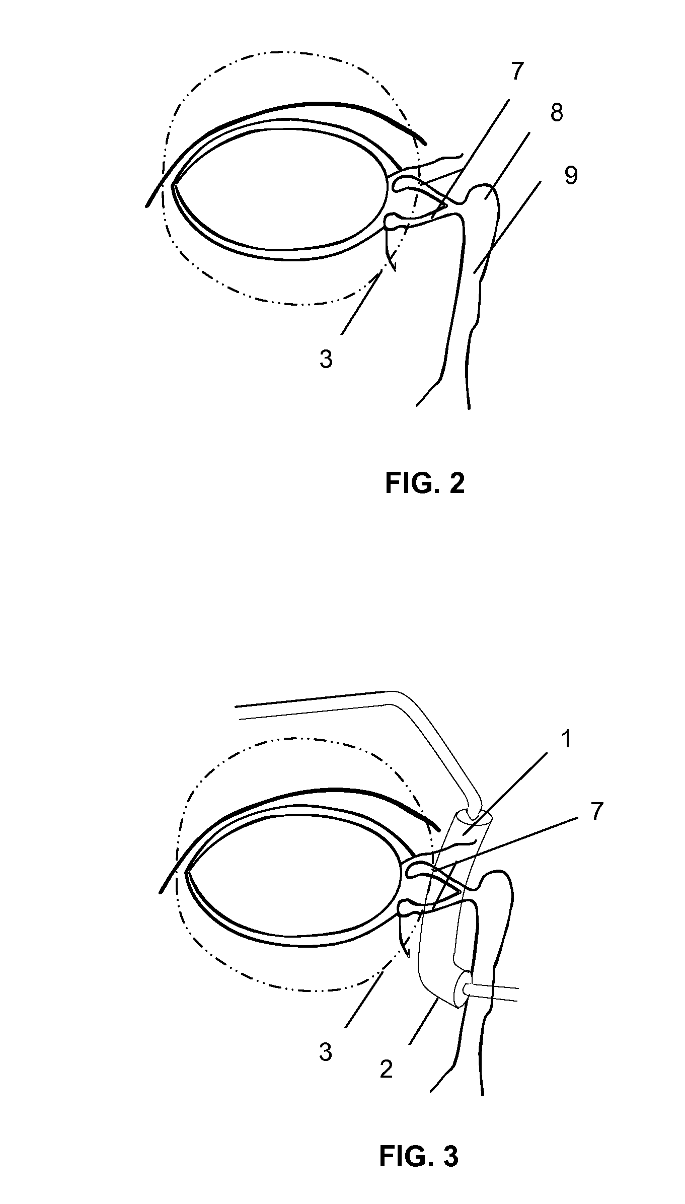 Noninvasive Lacrimal Canalicular Occlusion Device and Method