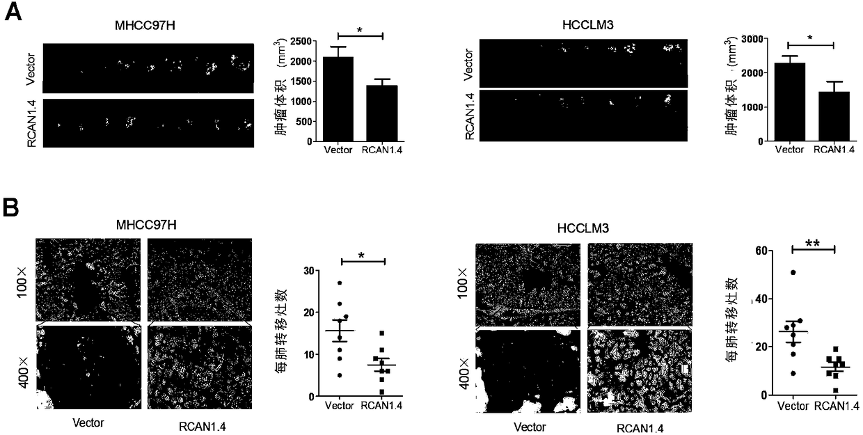 Applications of regulator of calcineurin 1.4 or analogues thereof in preparing medicines for inhibiting liver cancer