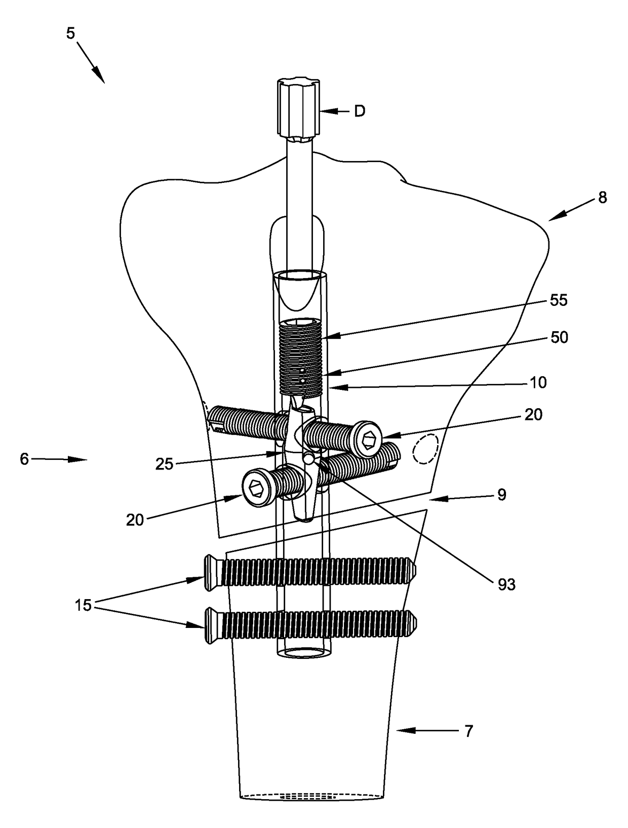 Interlocking intramedullary rod assembly for treating proximal tibial fractures