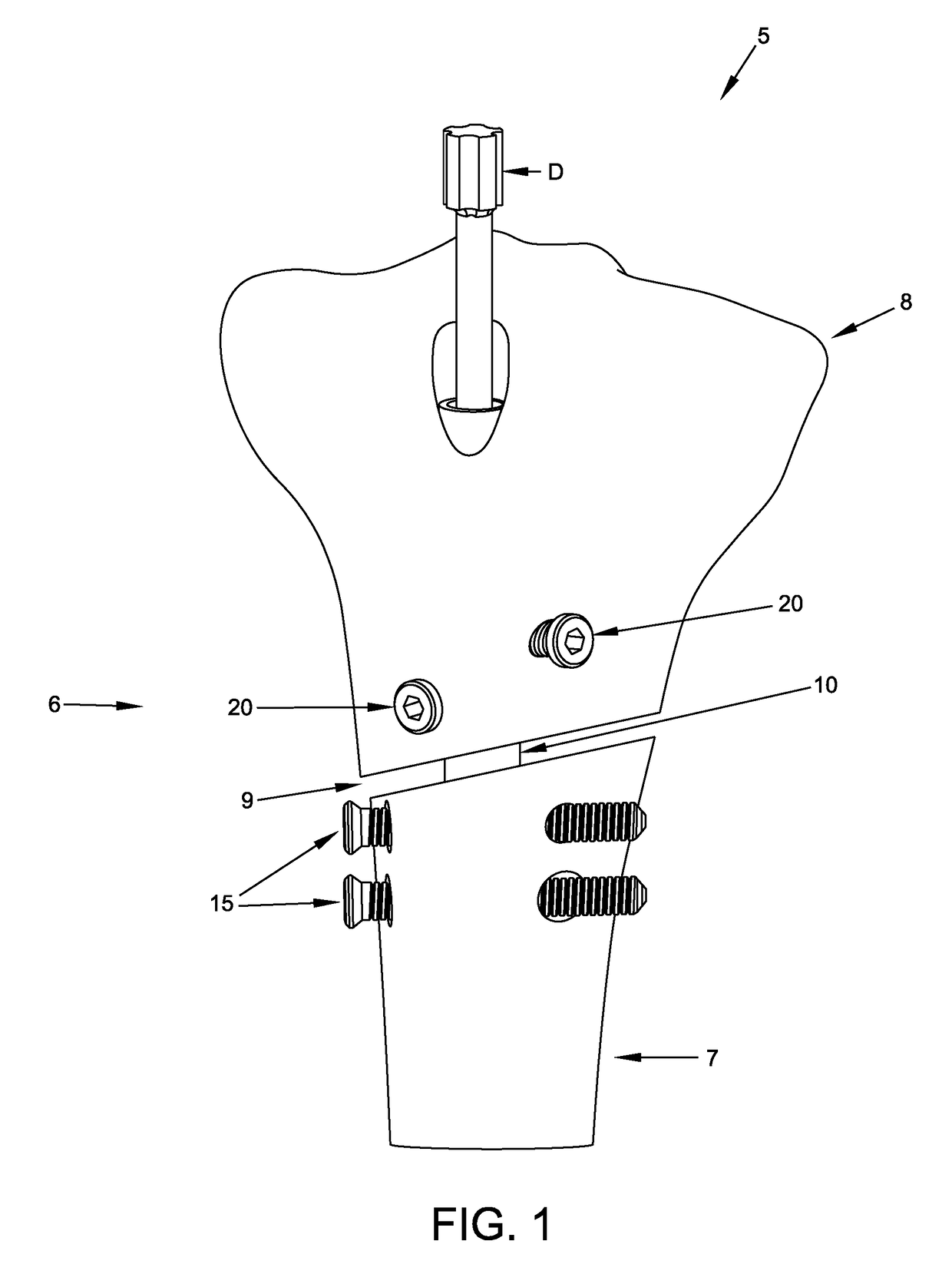 Interlocking intramedullary rod assembly for treating proximal tibial fractures