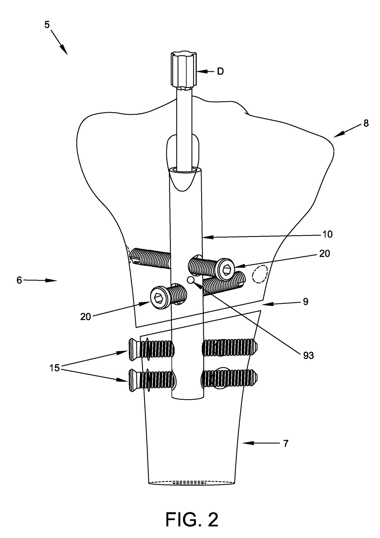 Interlocking intramedullary rod assembly for treating proximal tibial fractures