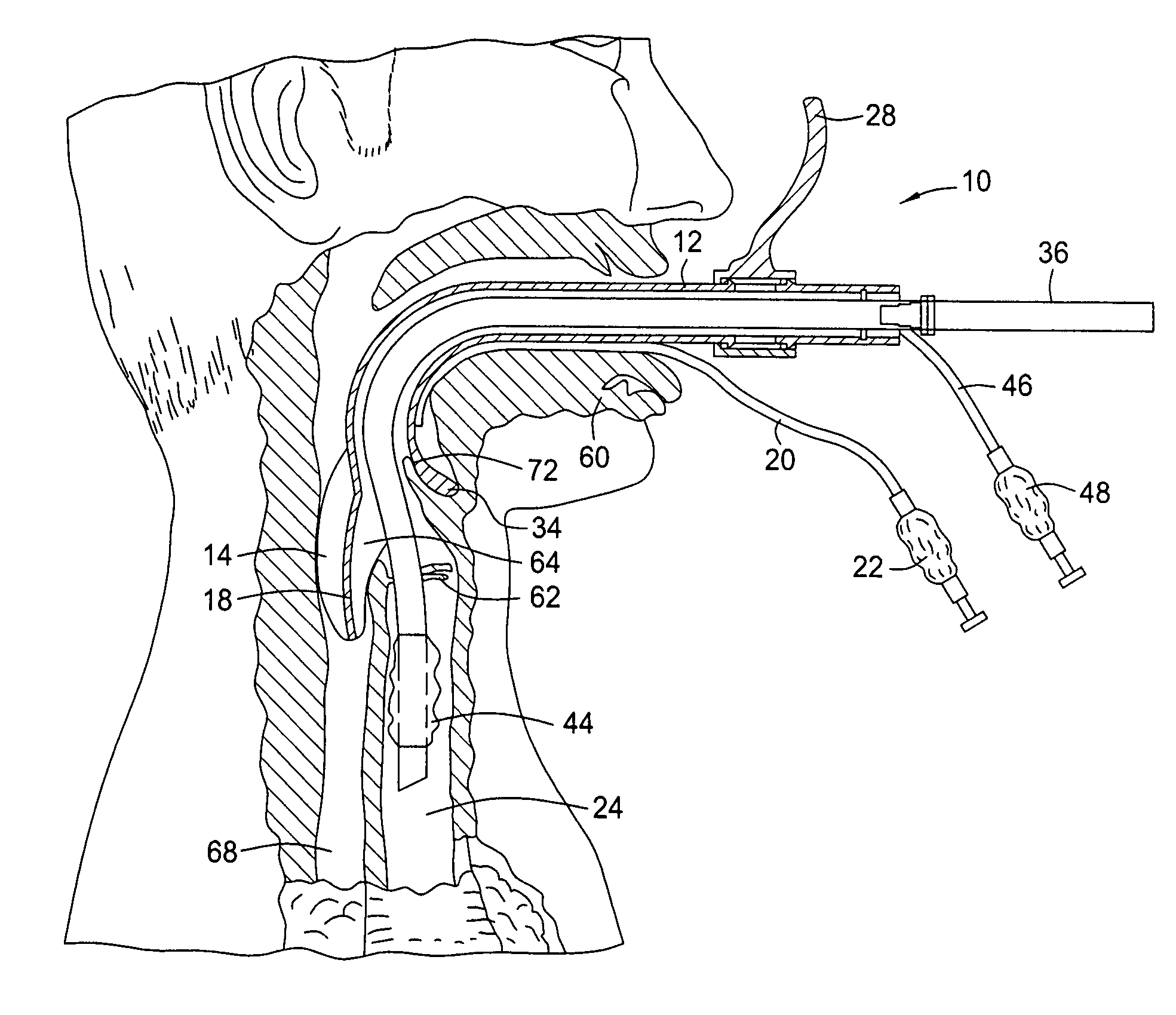 Device for insertion of endotracheal tube