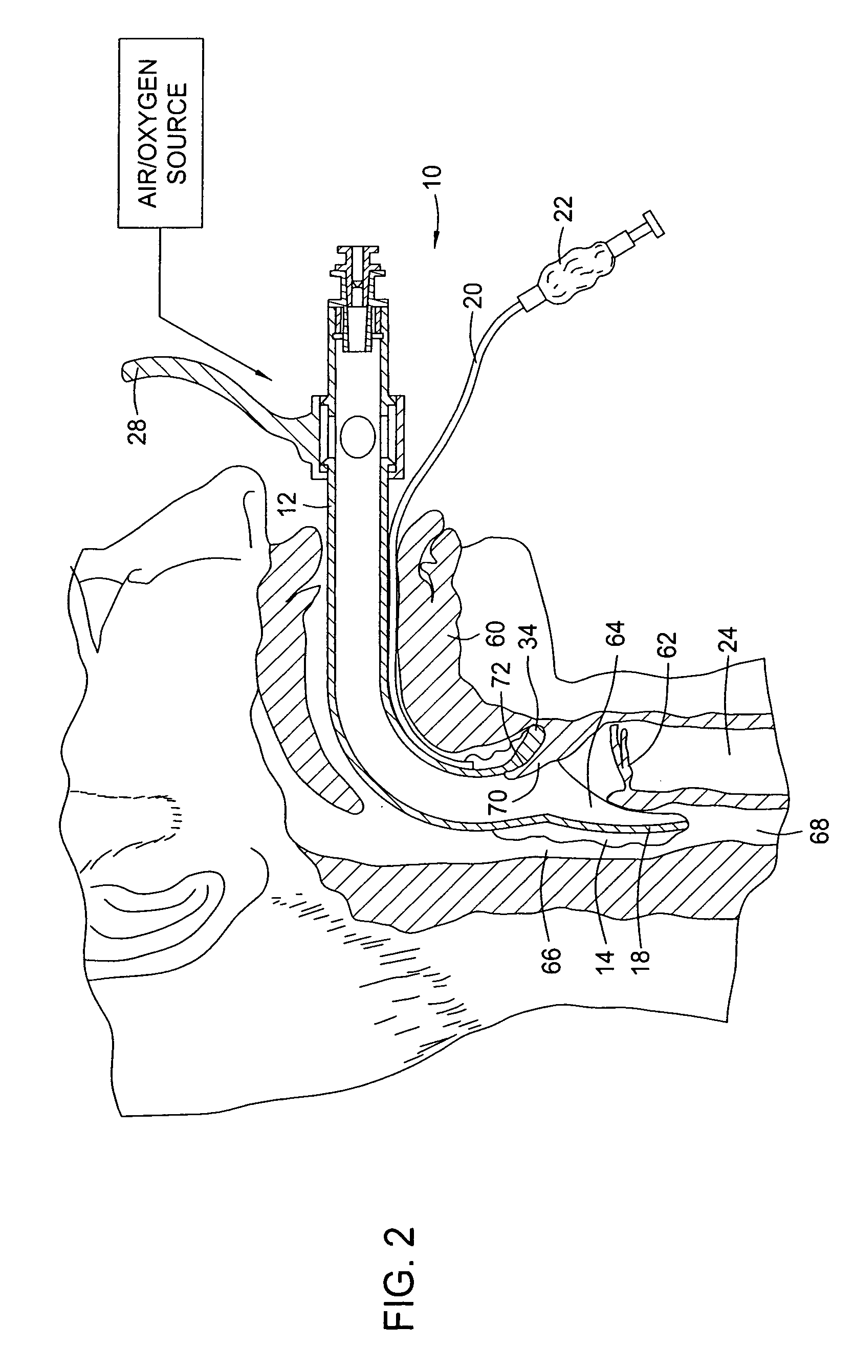 Device for insertion of endotracheal tube