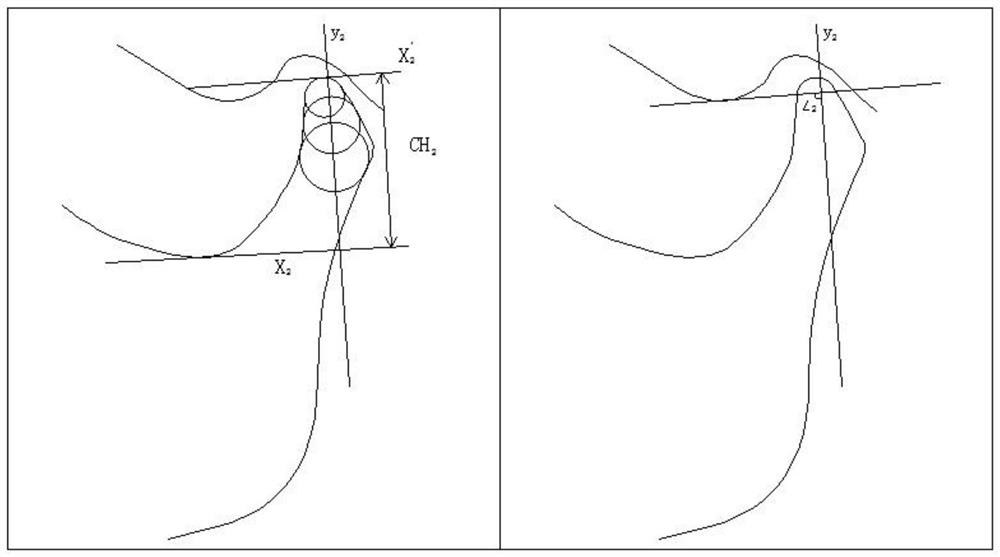 Quantitative measurement and analysis system for temporal-mandibular joint on magnetic resonance image