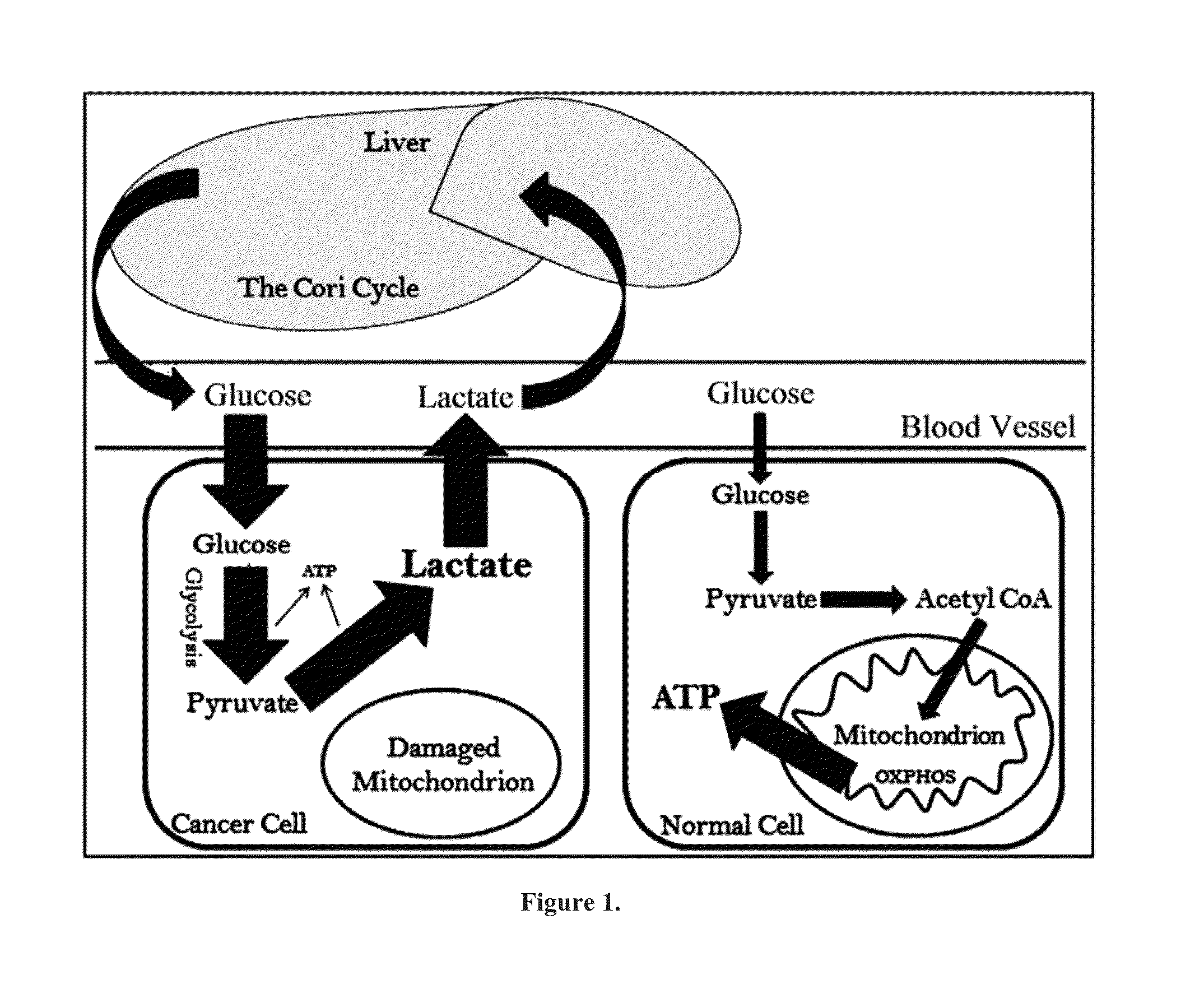 Targeting cancer with metabolic therapy and hyperbaric oxygen