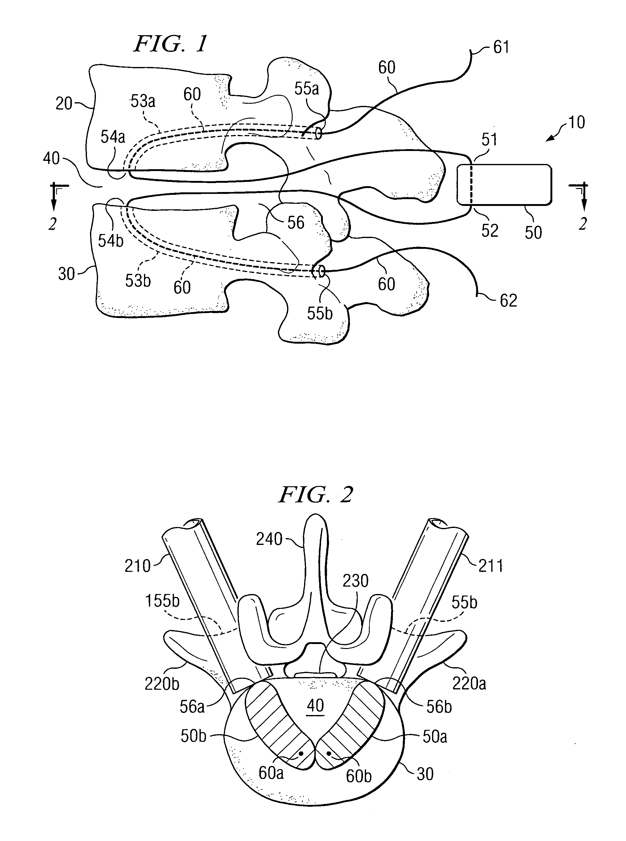 Nucleus replacement securing device and method