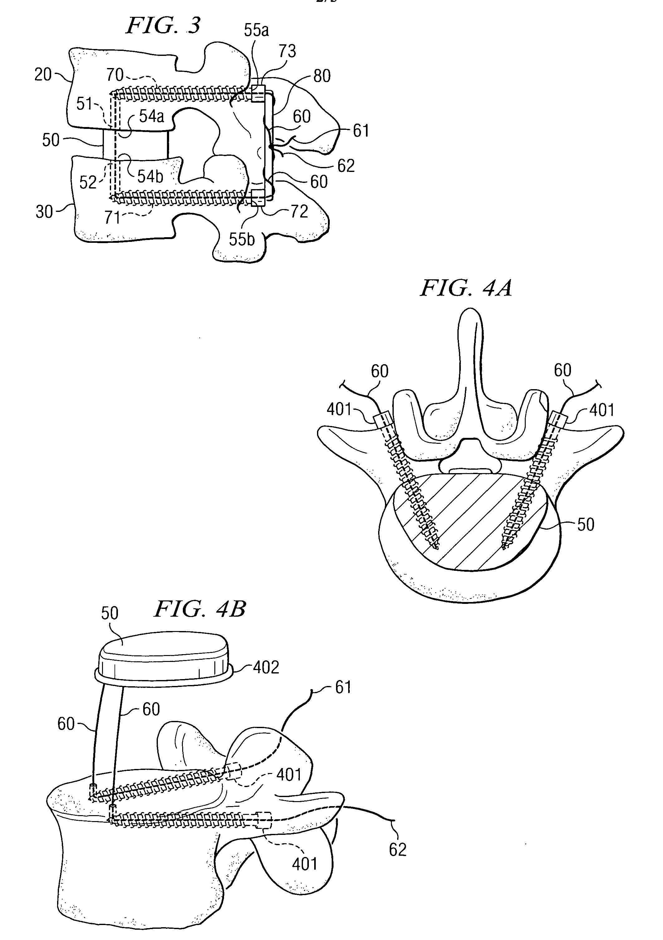 Nucleus replacement securing device and method