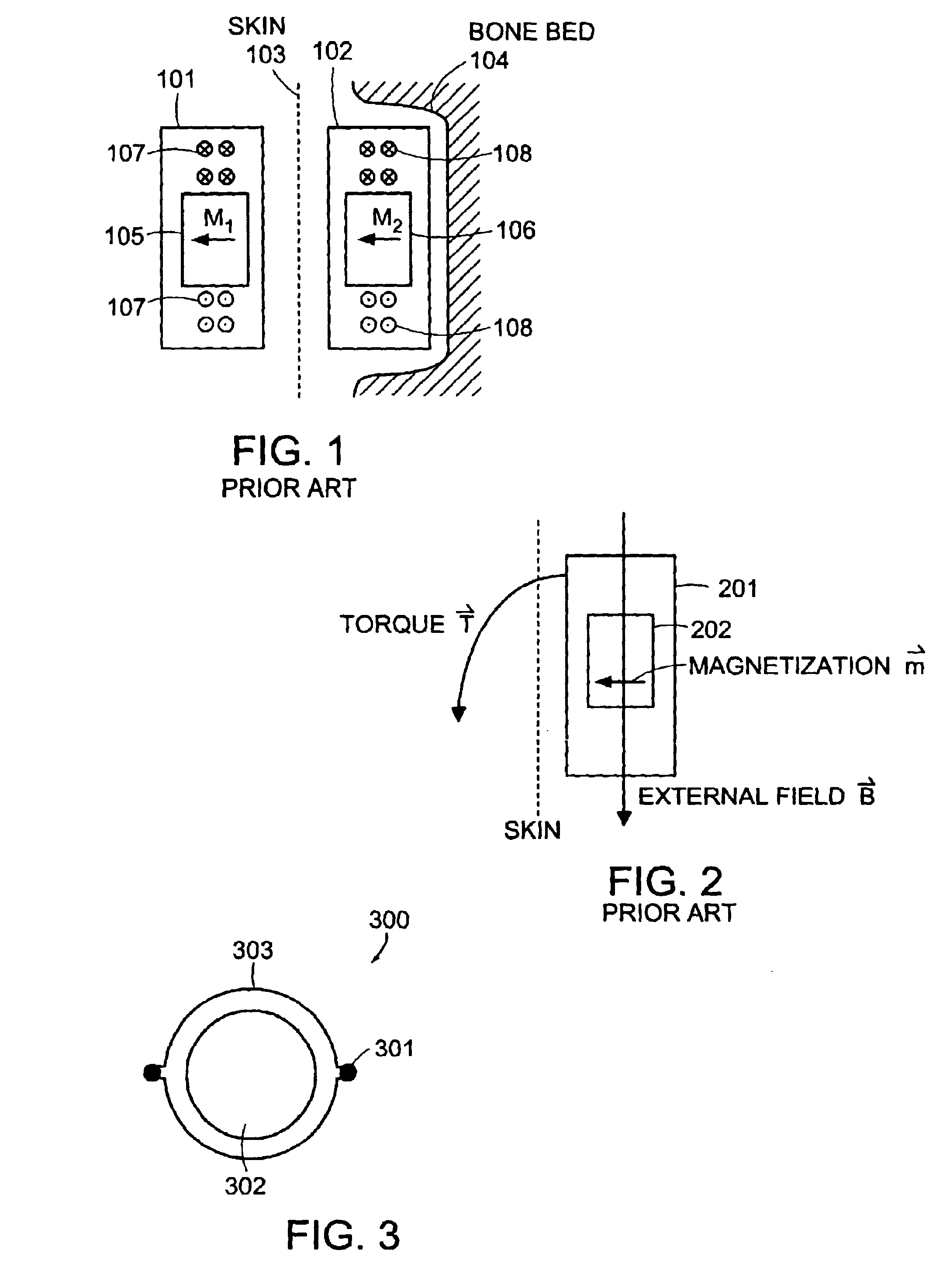 Reducing effects of magnetic and electromagnetic fields on an implant's magnet and/or electronics