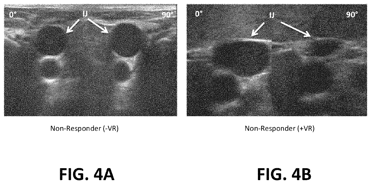 System and method for assessment of cardiac stroke volume and volume responsiveness