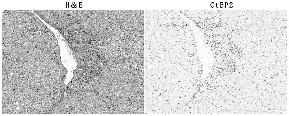 Application of ctbp2 in the preparation of diagnostic products for hepatocellular carcinoma and intrahepatic cholangiocarcinoma