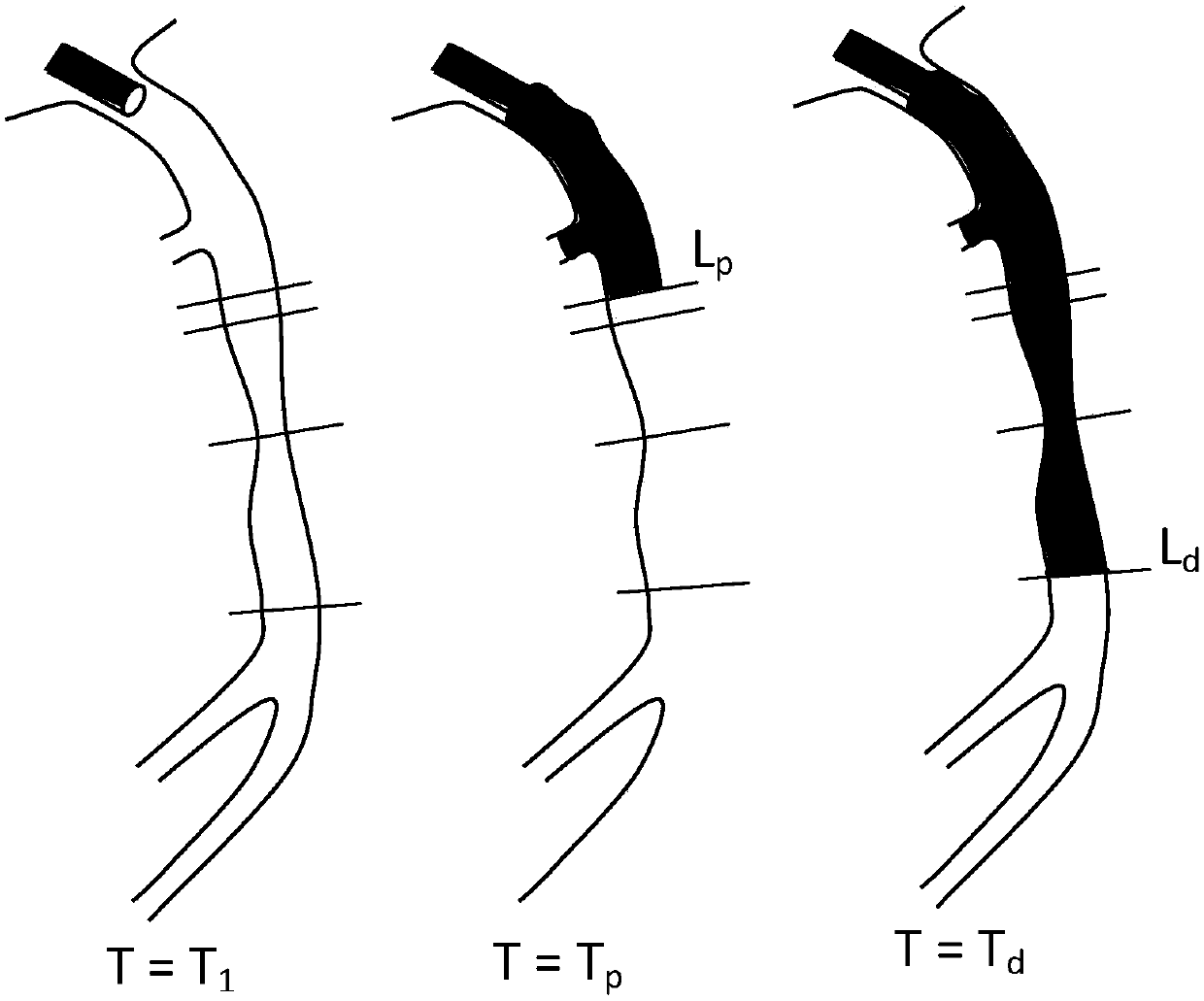 High-precision matching model-based method for calculating coronary artery parameters