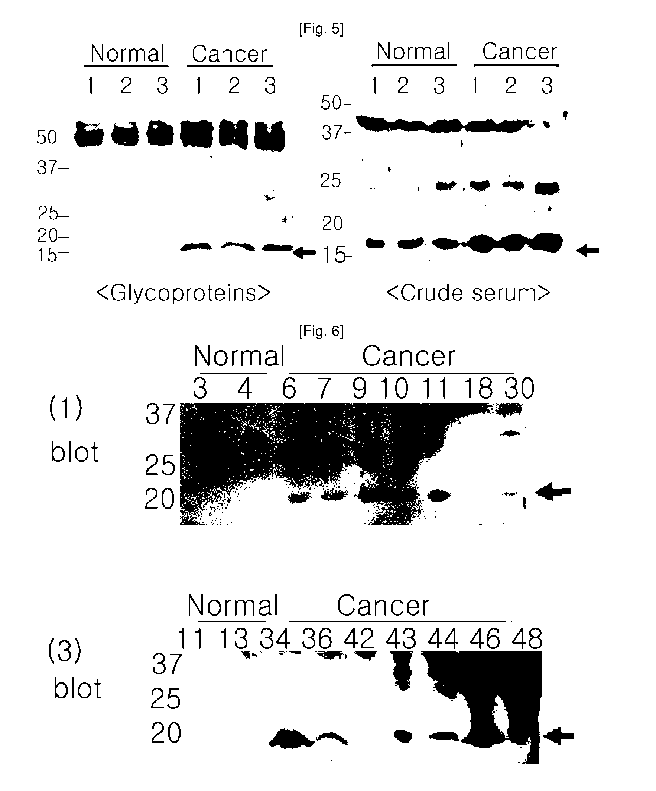 Plasma kallikrein fragments as diagnostic biomarkers for lung cancers