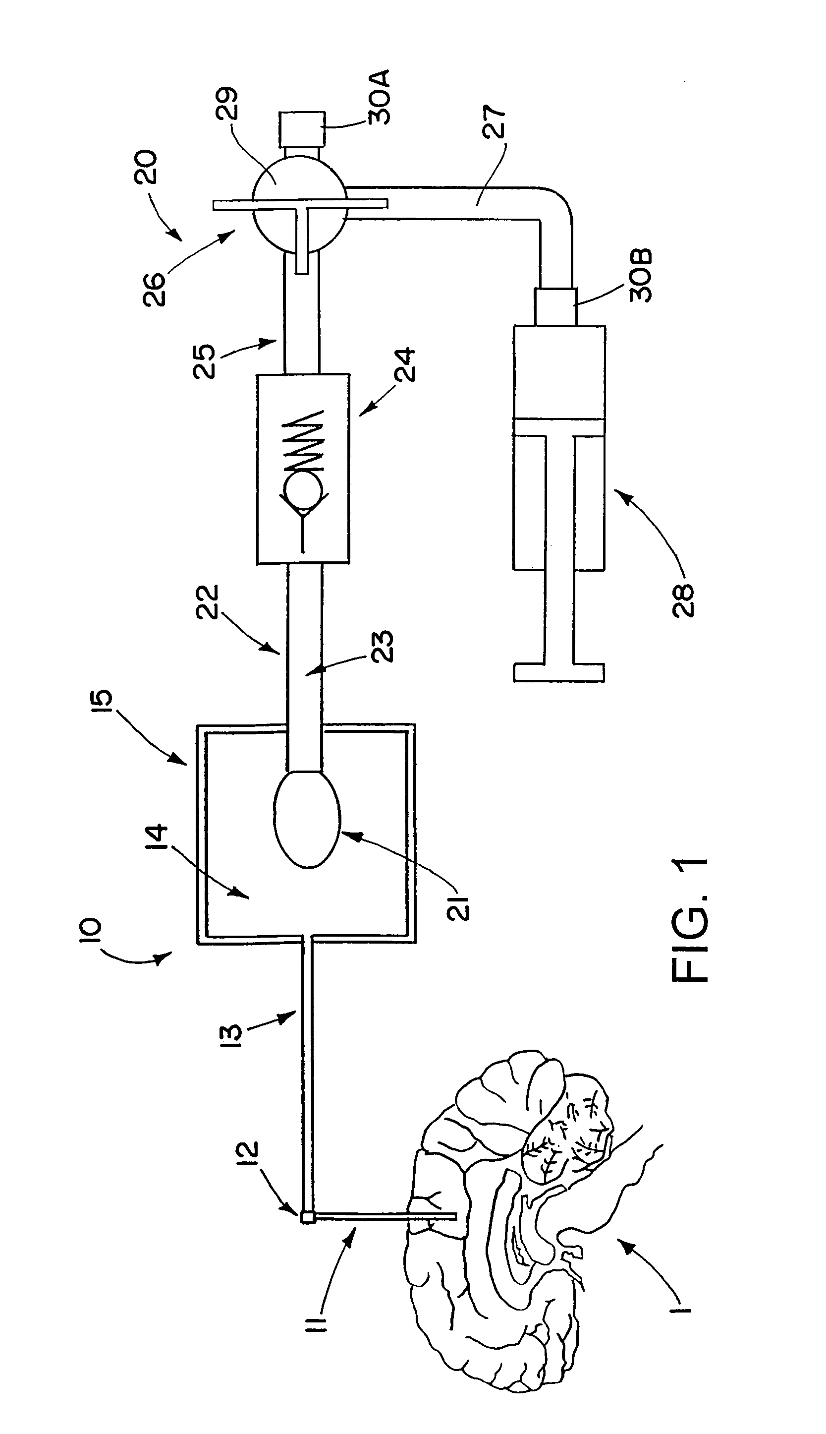 Drug supply system for CED (convection-enhanced delivery) catheter infusions