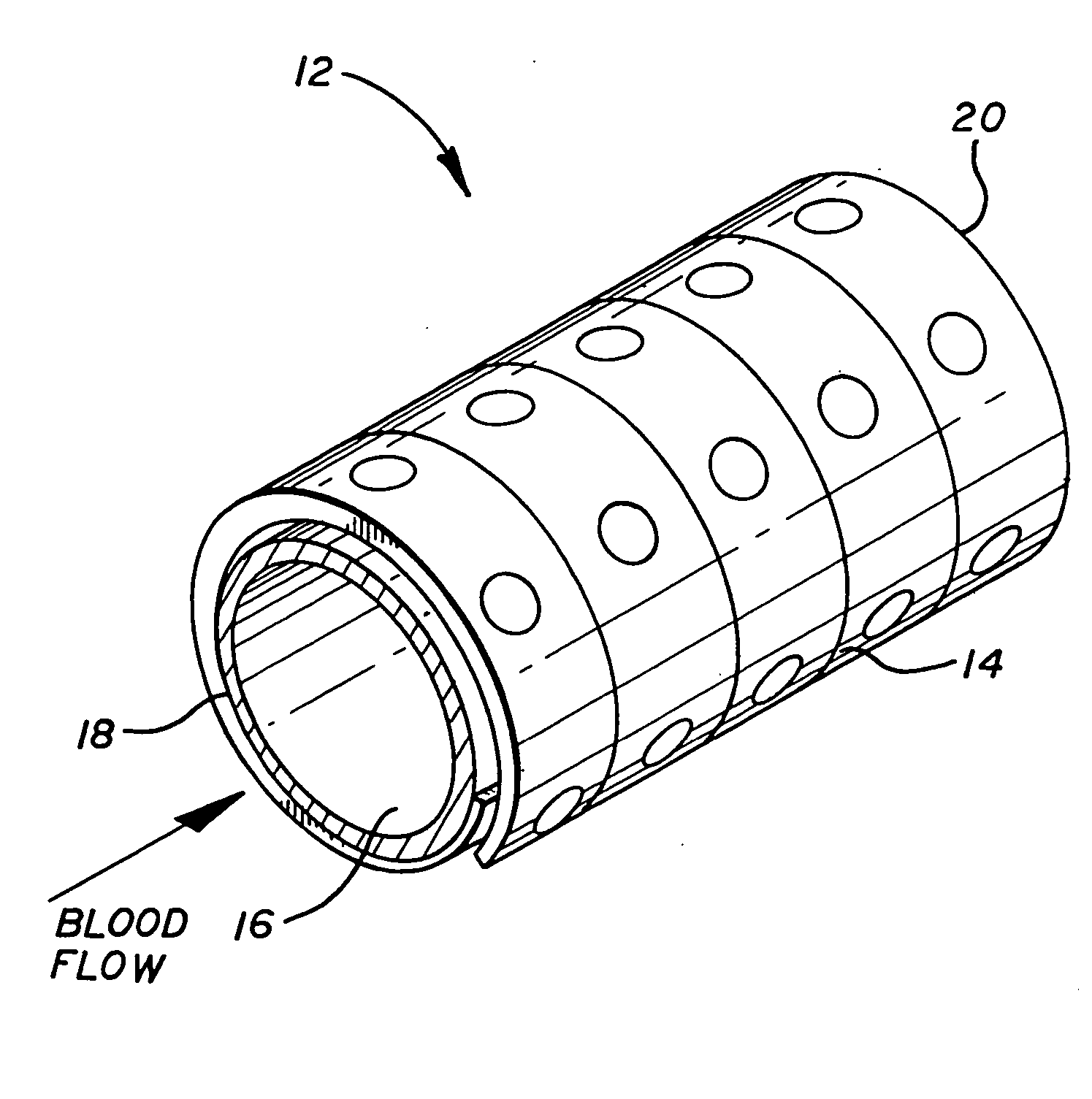 Coated endovascular stent