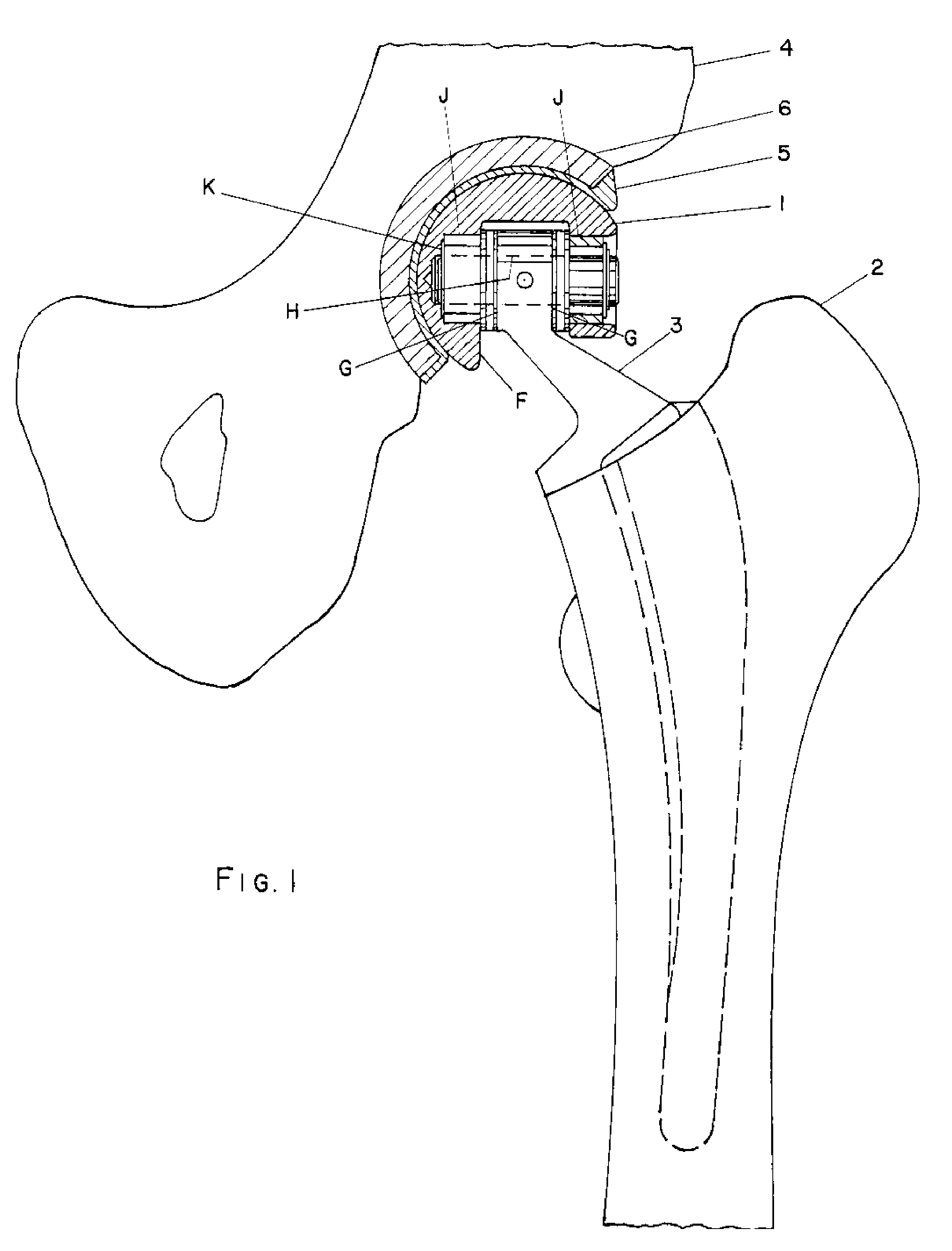 Hip prosthesis and the use thereof