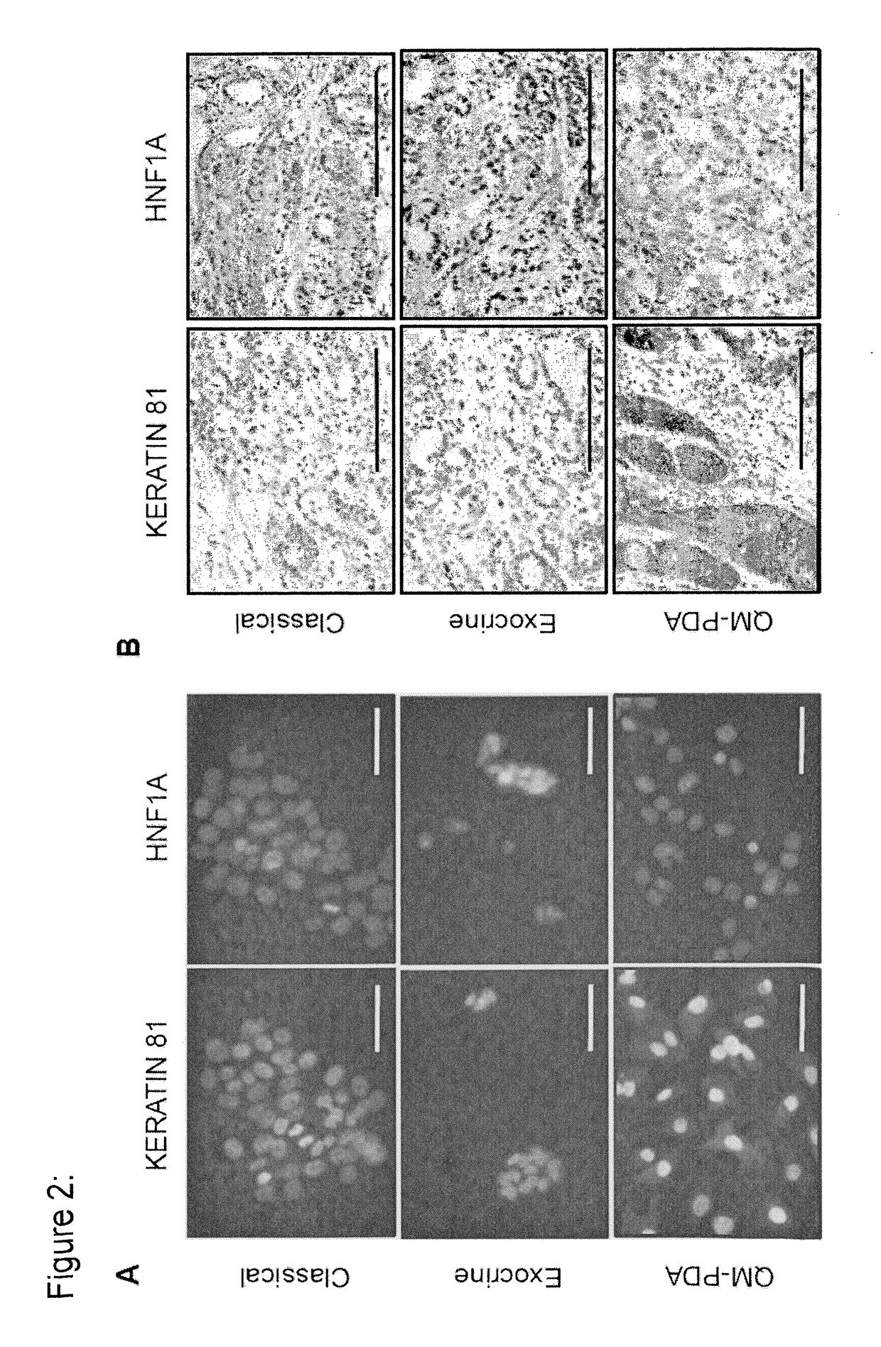 Novel methods for sub-typing and treating cancer