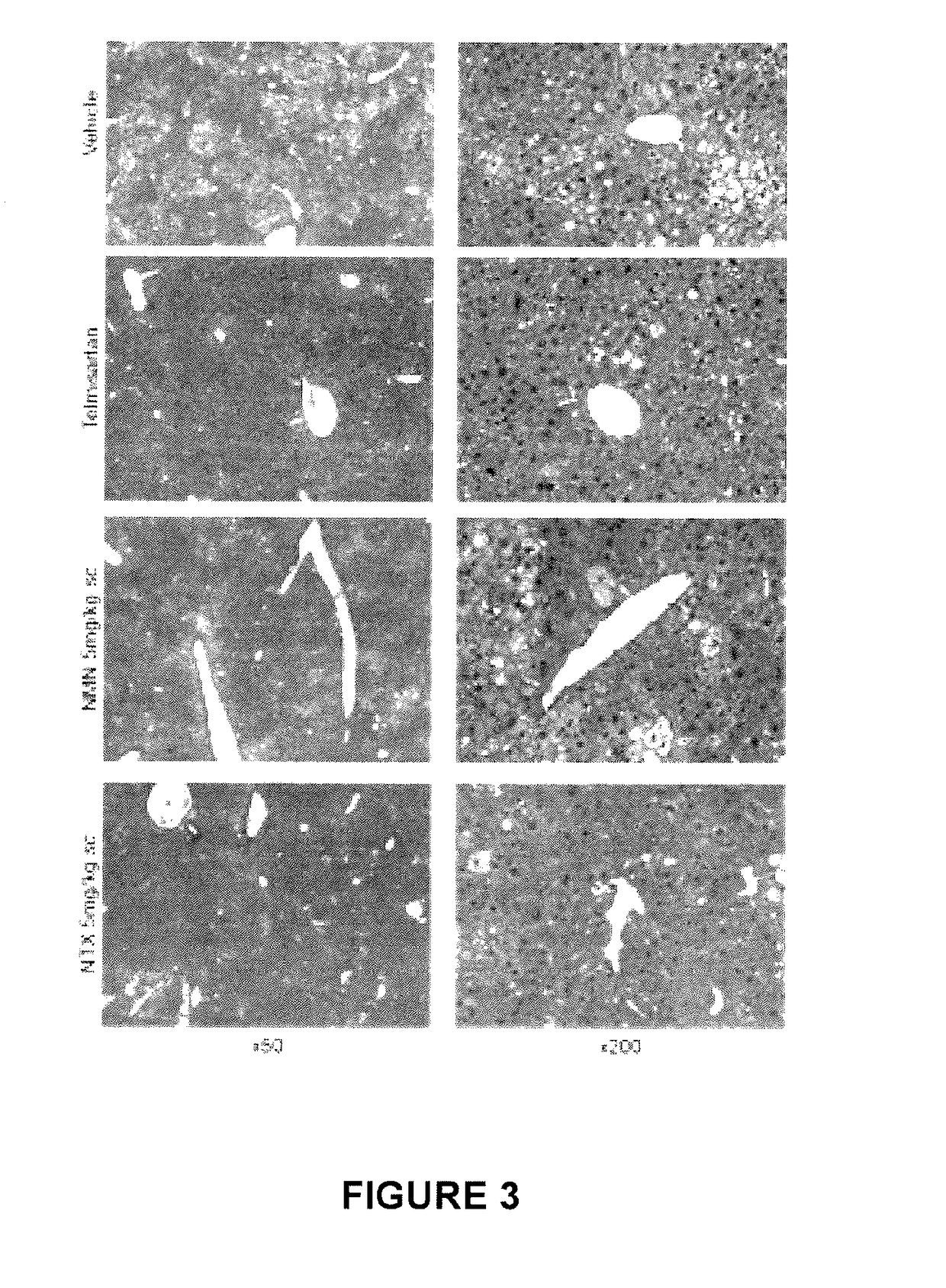 Use of nalmefene in non-alcoholic steatohepatitis