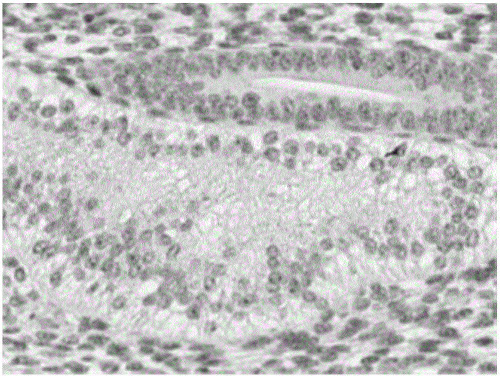 Marker of human endometrial cancer, antibody and application of antibody