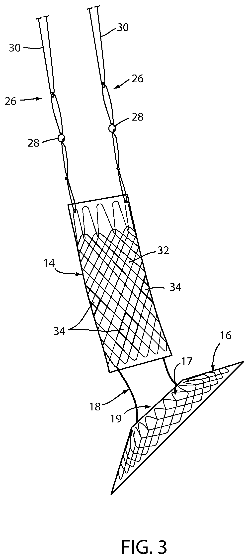 Fixation of intraluminal device