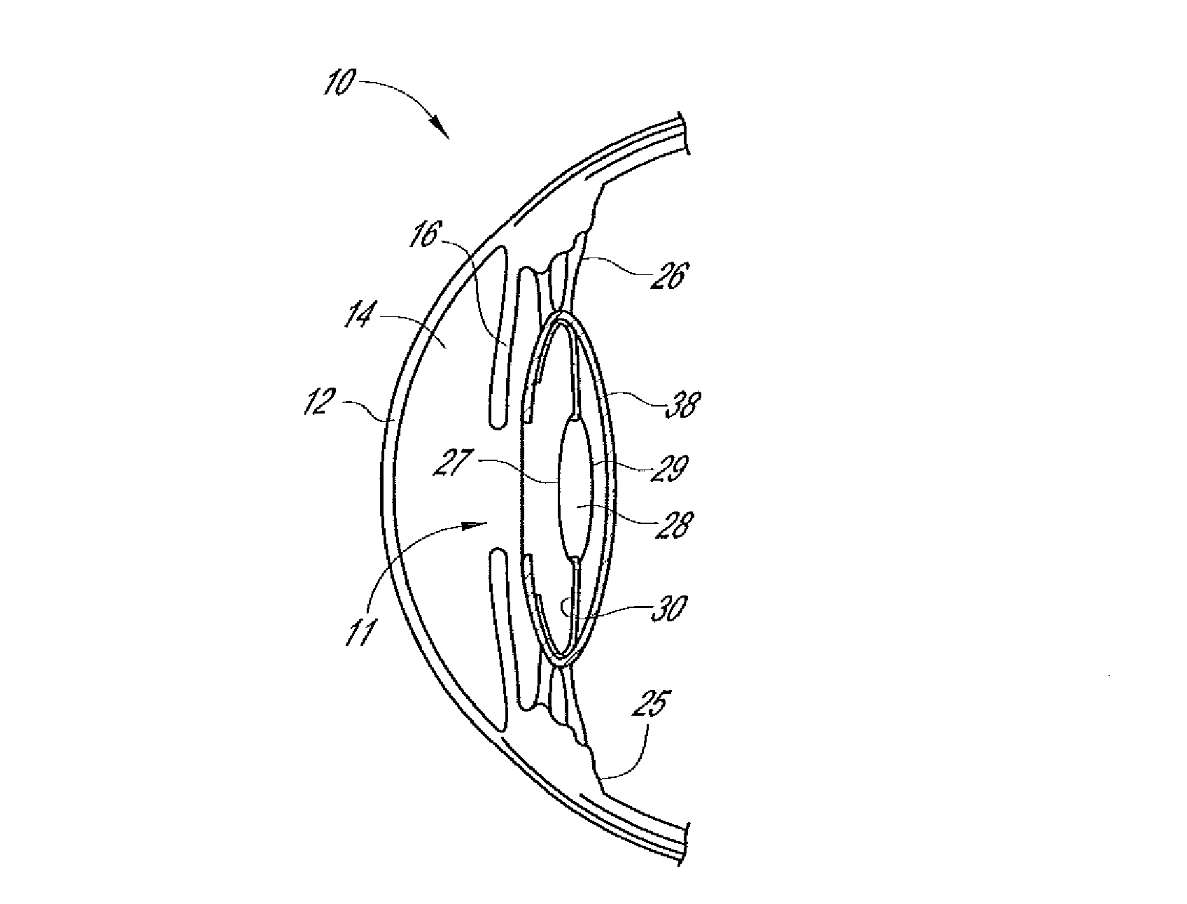 Intraocular lens with shape changing capability to provide enhanced accomodation and visual acuity