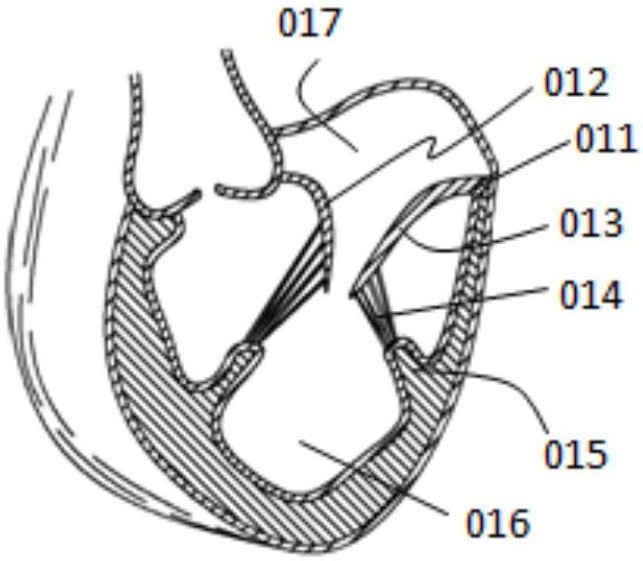 A step-by-step clamping valve prosthesis and its delivery system