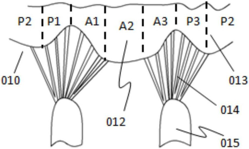 A step-by-step clamping valve prosthesis and its delivery system