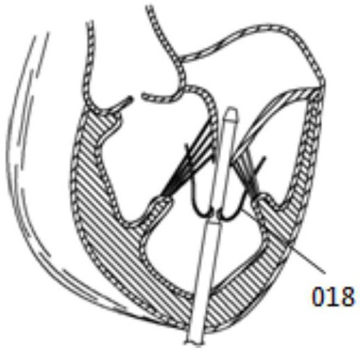 A step-by-step clamping valve prosthesis and its delivery system