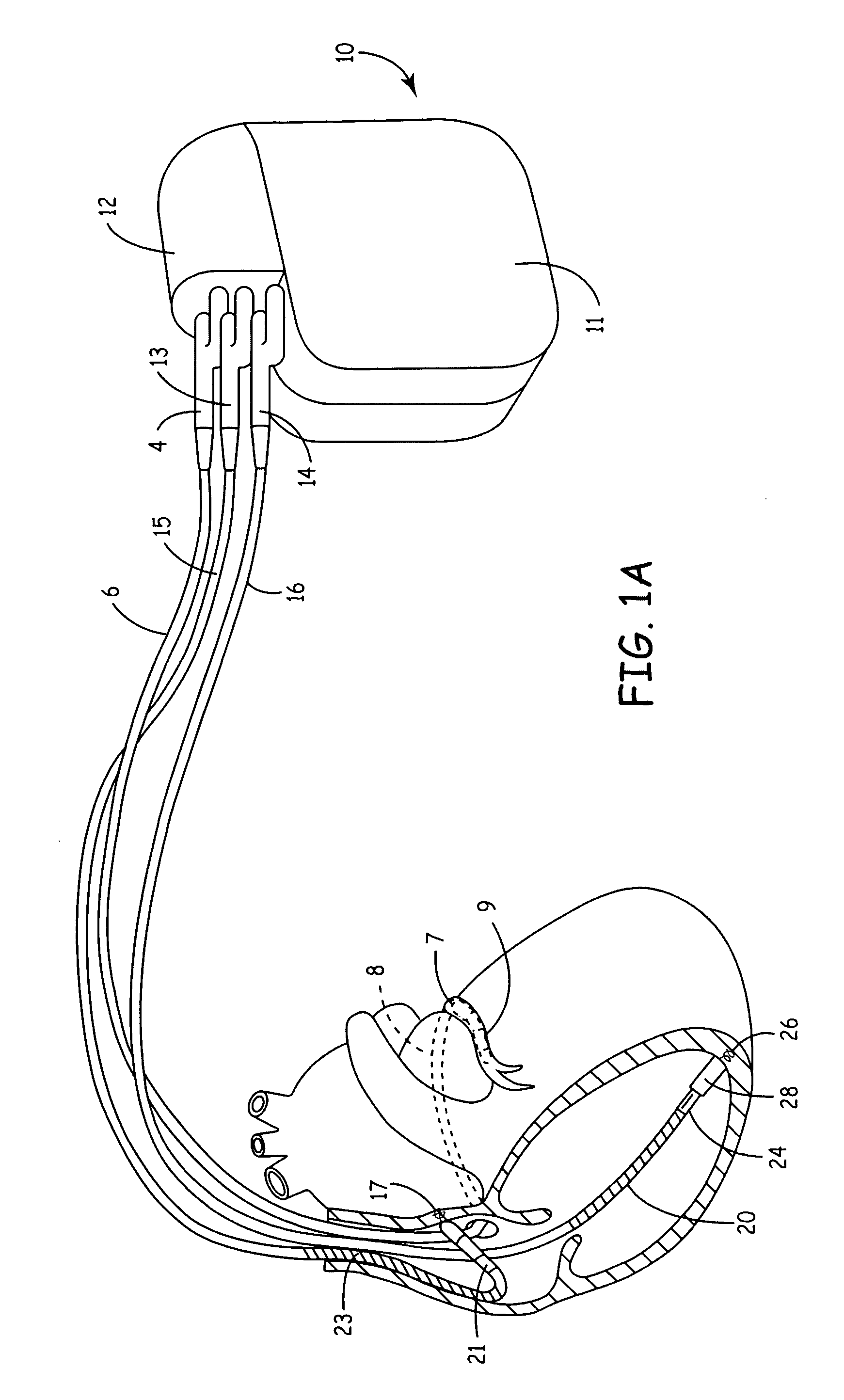 Method and apparatus for controlling extra-systolic stimulation (ESS) therapy using ischemia detection