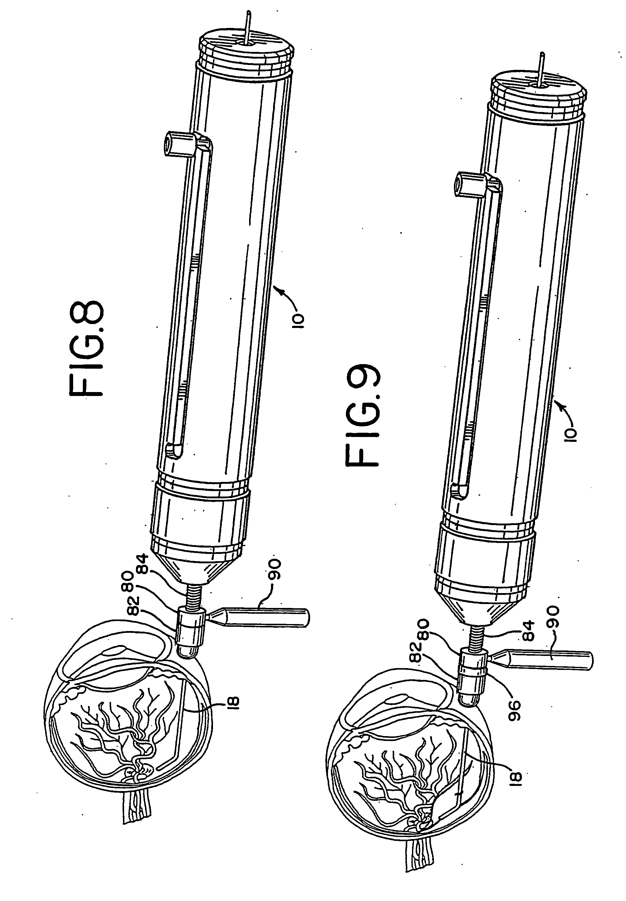 Methods and apparatus for intraocular brachytherapy