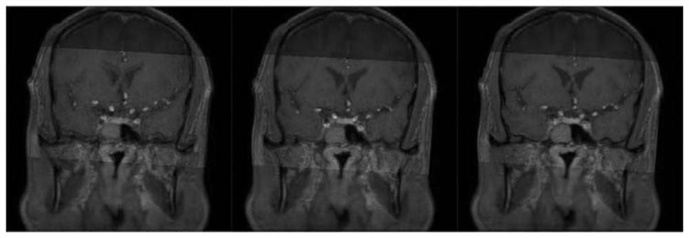 Intracranial blood vessel image registration method