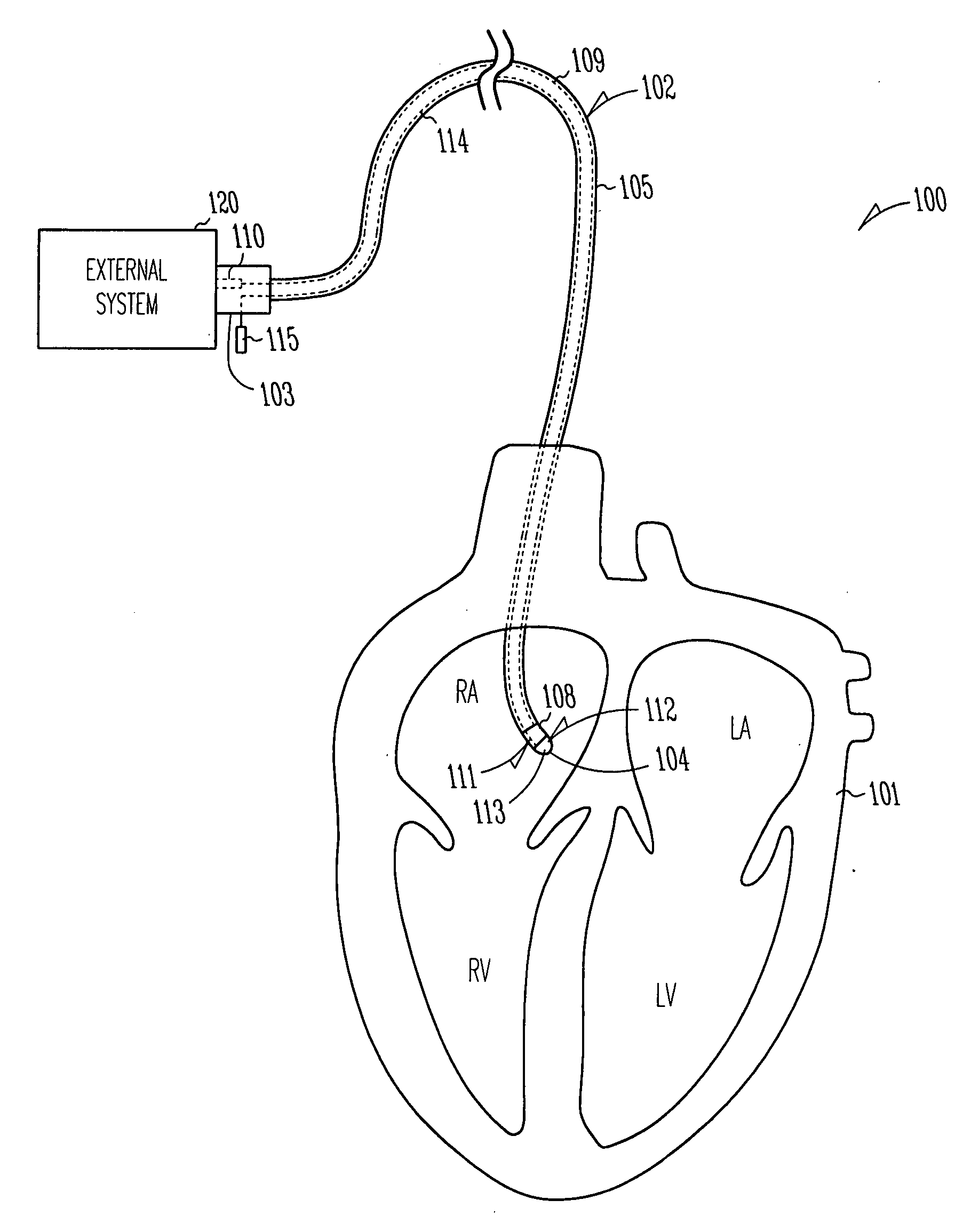 Systems and devices for photoablation