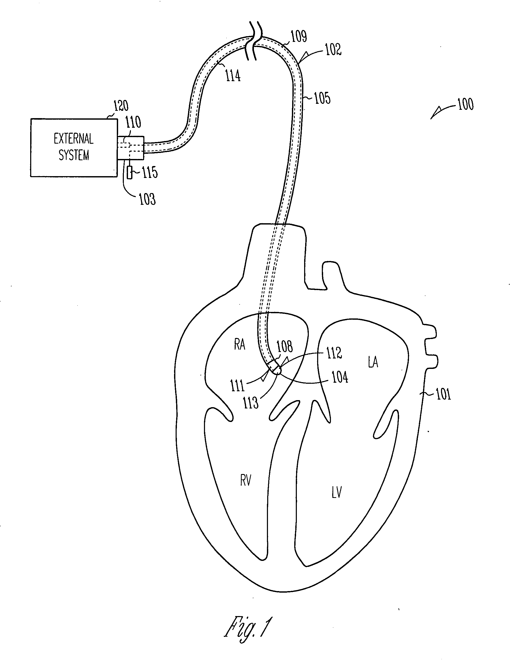 Systems and devices for photoablation