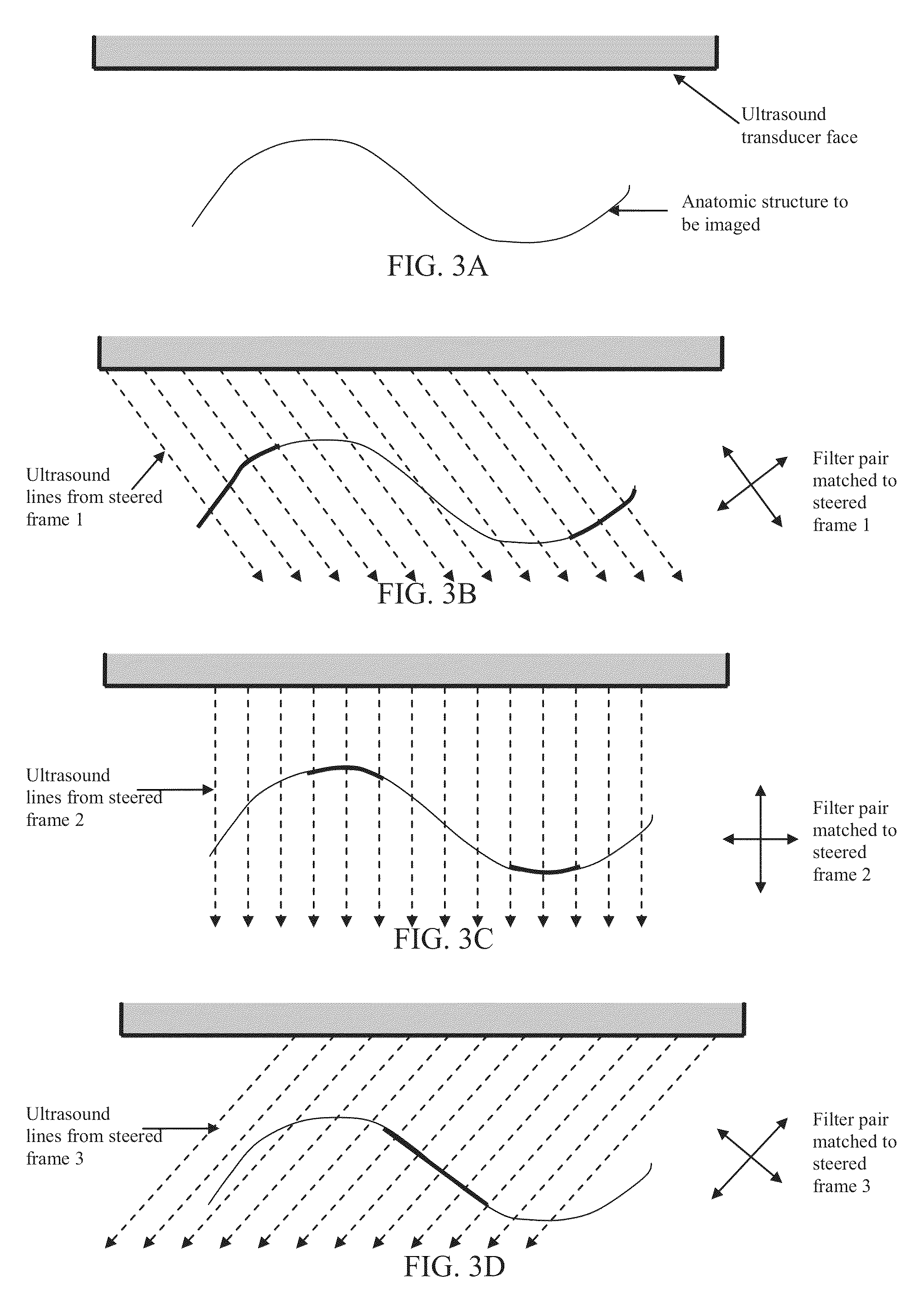 Component frame enhancement for spatial compounding in ultrasound imaging