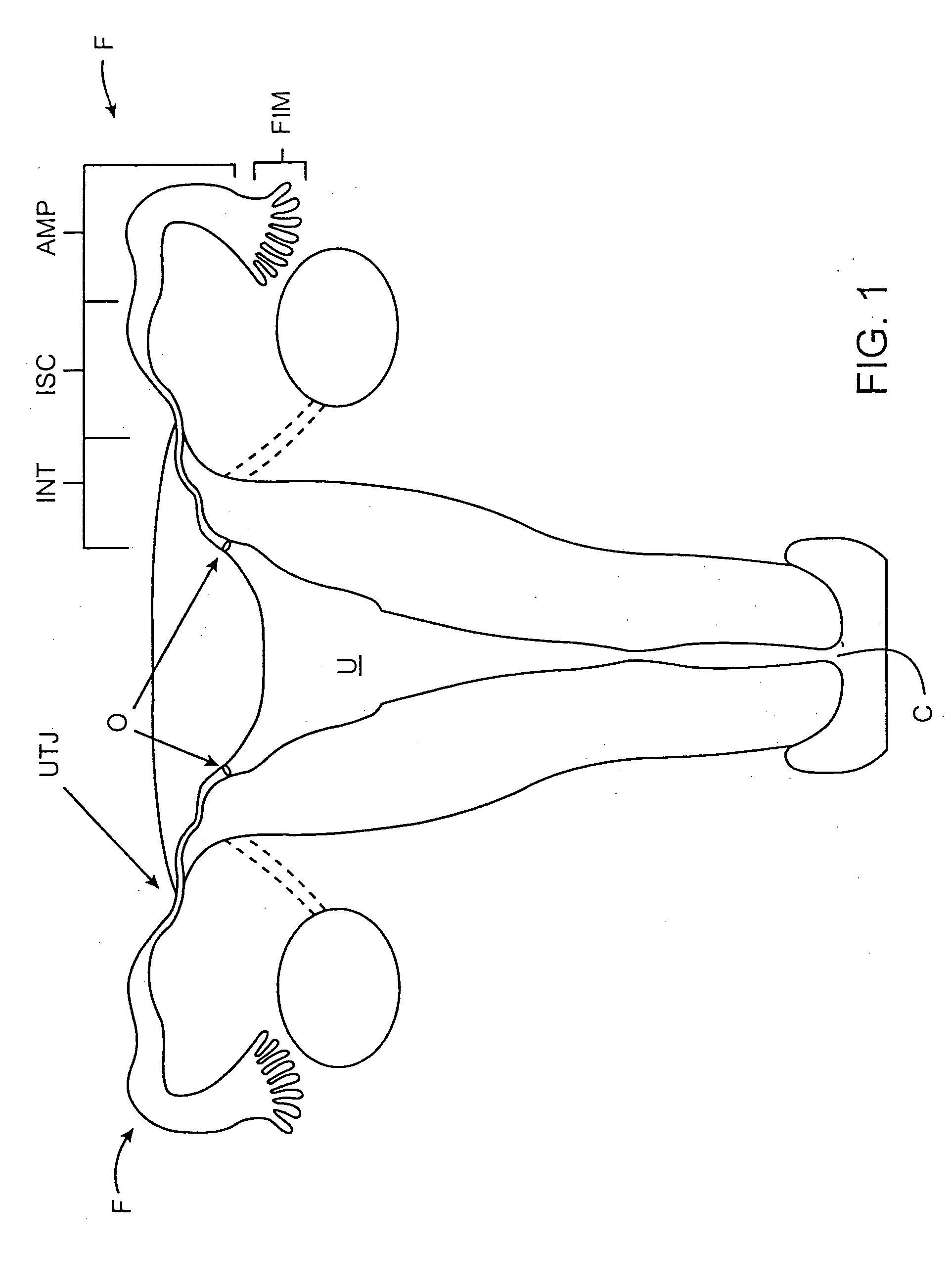 Insertion/deployment catheter system for intrafallopian contraception