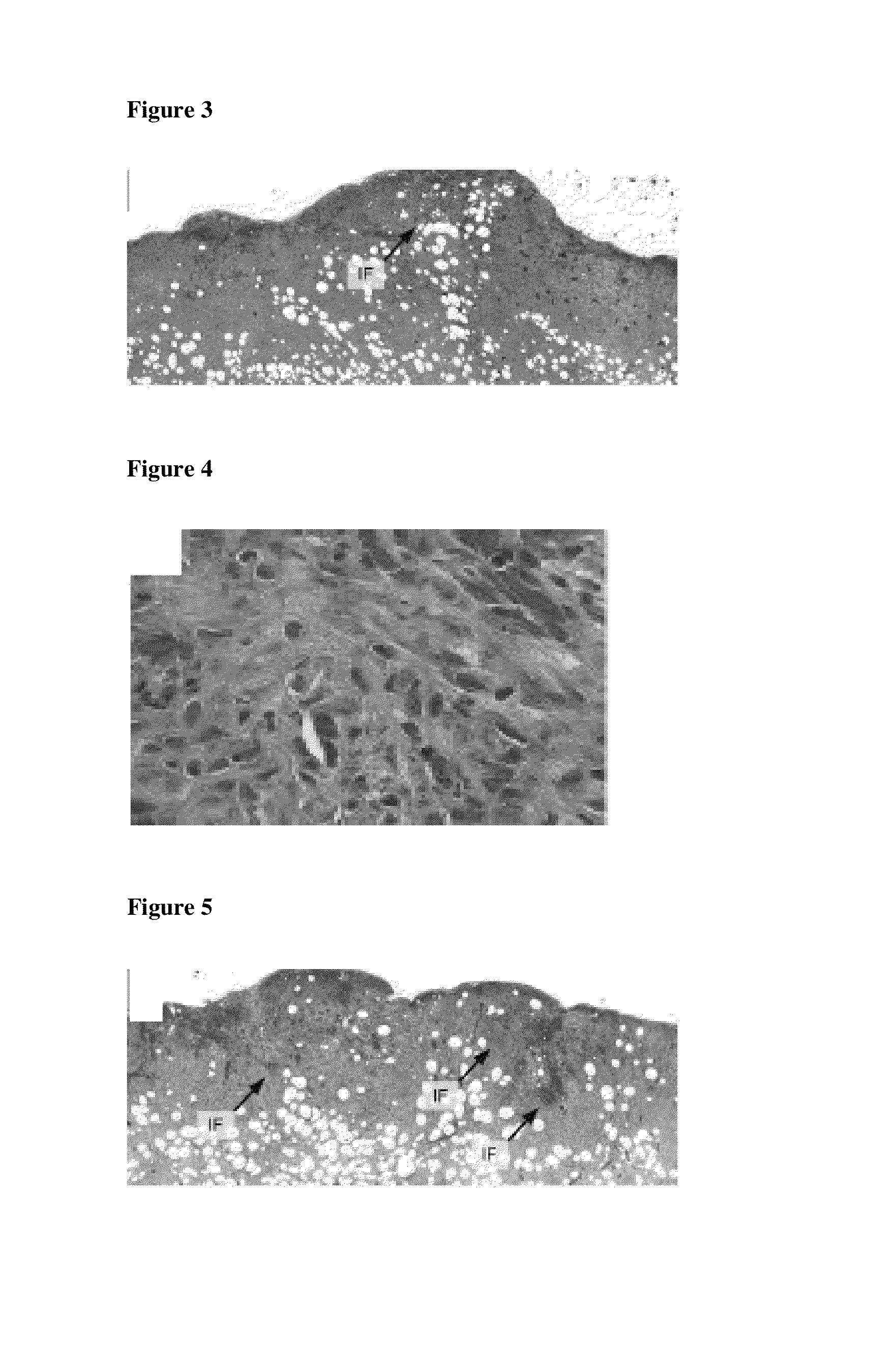 Use of a polyurethane foam as a wound dressing in negative pressure therapy