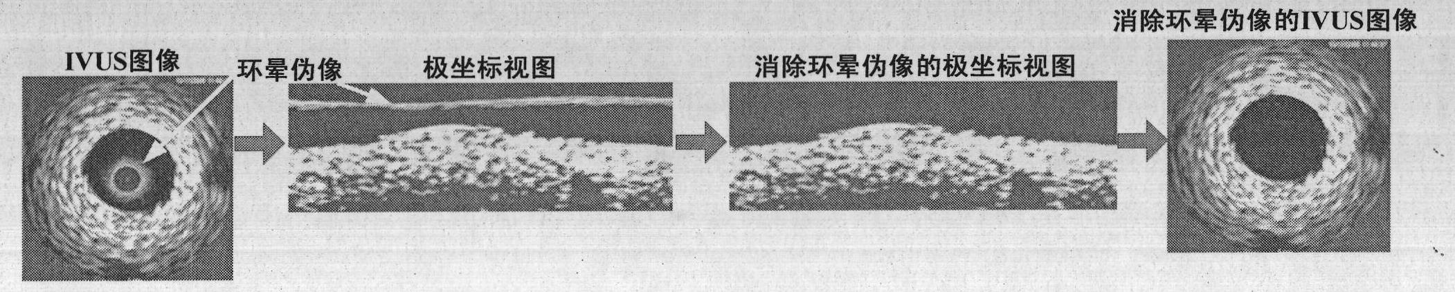 Three-dimensional segmentation method for intravascular ultrasound image sequence