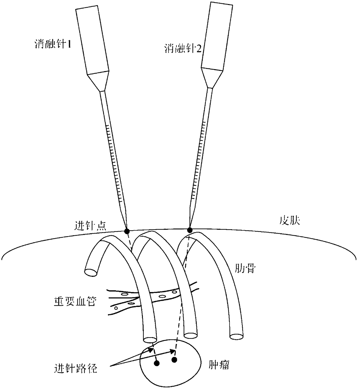 Microwave ablation treatment planning method based on CT image